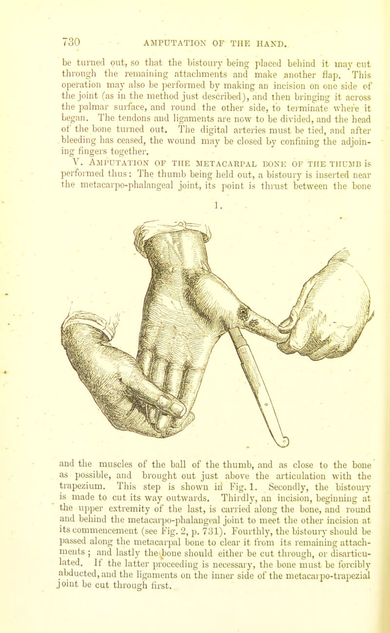 be turned out, so that the bistoury being placed beliind it uia_v cut through the remaining attachments and malie another flap. This operation may also be perfoimed by making an incision on one side of the joint fas in the method just described), and then bringing it across the palmar surface, and round the other side, to tei-minate where it began. The tendons and ligaments are now to be divided, and the head of the bone turned out. The digital arteries must be tied, and after bleeding has ceased, the wound may be closed by confining the adjoin- ing fingers togethei-. V. Amputation or the metacarpal bone of the thumb is performed thus: The thumb being held out, a bistoury is inserted near the metacarpo-phalangeal joint, its point is thrast between the bone 1. and the muscles of the ball of the thumb, and as close to the bone as possible, and brought out just above the ai'ticulation with the trapezium. Tliis step is shown in Fig. 1. Secondly, the bistoury is made to cut its way outwards. Thiidly, au incision, beginning at the upper extremity of the last, is cariied along the bone, and round and behind the metacar])o-phalangeal joint to meet the other incision at its commencement (see Fig. 2, p. 731). Fourthly, the bistoury should be passed along the niebicarpal boue to clear it from its remaining attach- ments ; and lastly the bone should either be cut thiough, or disarticu- lated. If the latter proceeding is necessary, the bone must be forcibly abducted, and the ligaments on the inner side oi'the metacai po-trapezial joint be cut through first.