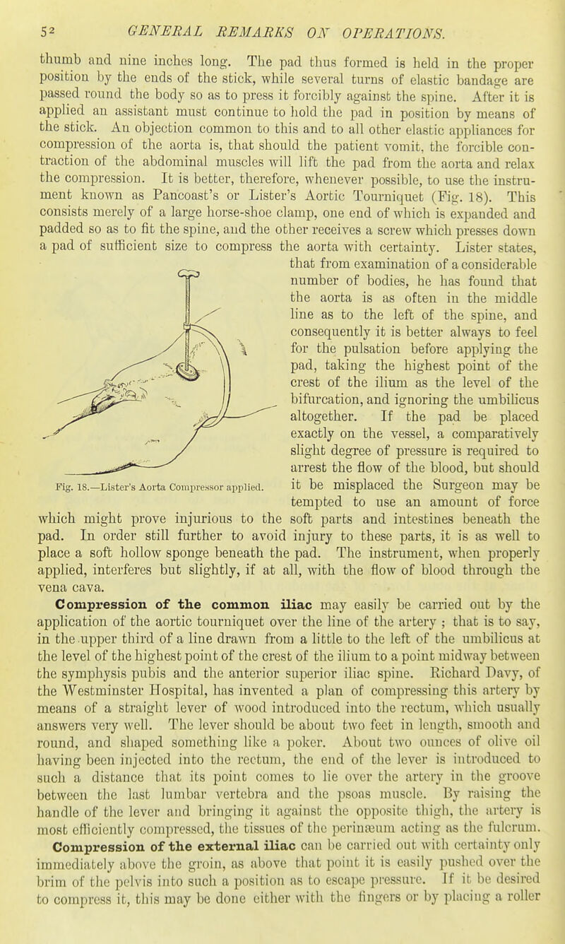 thumb and nine inches long. The pad thus formed is held in the proper position by the ends of the stick, while several turns of elastic bandage are passed round the body so as to press it forcibly against the spine. After it is applied an assistant must continue to hold the pad in position by means of the stick. An objection common to this and to all other elastic apphances for compression of the aorta is, that should the patient vomit, the forcible con- traction of the abdominal muscles will lift the pad from the aorta and relax the compression. It is better, therefore, whenever possible, to use the instru- ment known as Pancoast's or Lister's Aortic Tourniquet (Fig. 18). This consists merely of a large horse-shoe clamp, one end of which is expanded and padded so as to fit the spine, and the other receives a screw which presses down a pad of sufficient size to compress the aorta with certainty. Lister states, that from examination of a considerable number of bodies, he has found that the aorta is as often in the middle hne as to the left of the spine, and consequently it is better always to feel for the pulsation before applying the pad, taking the highest point of the crest of the ilium as the level of the bifiircation, and ignoring the umbihcus altogether. If the pad be placed exactly on the vessel, a comparatively slight degree of pressure is required to arrest the flow of the blood, but should Fig. IS.—Lister's Aorta Compressor applied. it be misplaCCd the SurgeOn may be tempted to use an amount of force which might prove injurious to the soft parts and intestines beneath the pad. In order still further to avoid injury to these parts, it is as well to place a soft hollow sponge beneath the pad. The instrument, when properly applied, interferes but slightly, if at all, with the flow of blood through the vena cava. Compression of the common iliac may easily be carried out by the application of the aortic tourniquet over the line of the artery ; that is to say, in the upper third of a line drawn from a little to the left of the umbilicus at the level of the highest point of the crest of the ilium to a point midway between the symphysis pubis and the anterior superior iliac spine. Richard Davy, of the Westminster Hospital, has invented a plan of compressing this artery by means of a straight lever of wood introduced into the rectum, which usually answers very well. The lever should be about two feet in length, smooth and round, and shaped something like a poker. About two ounces of olive oil having been injected into the rectum, the end of the lever is introduced to such a distance that its point comes to he over the artery in the groove between the last lumbar vertebra and the psoas muscle. By raising the handle of the lever and bringing it agaiust the opposite thigh, the artery is most efficiently compressed, the tissues of the perinajum acting as the fulcrum. Compression of the external iliac can be carried out with certainty only immediately above the groin, as above that point it is easily pushed over the brim of the pelvis into such a position as to escape pressure. If it be desired to compress it, this may be done either with the fingers or by placing a roller