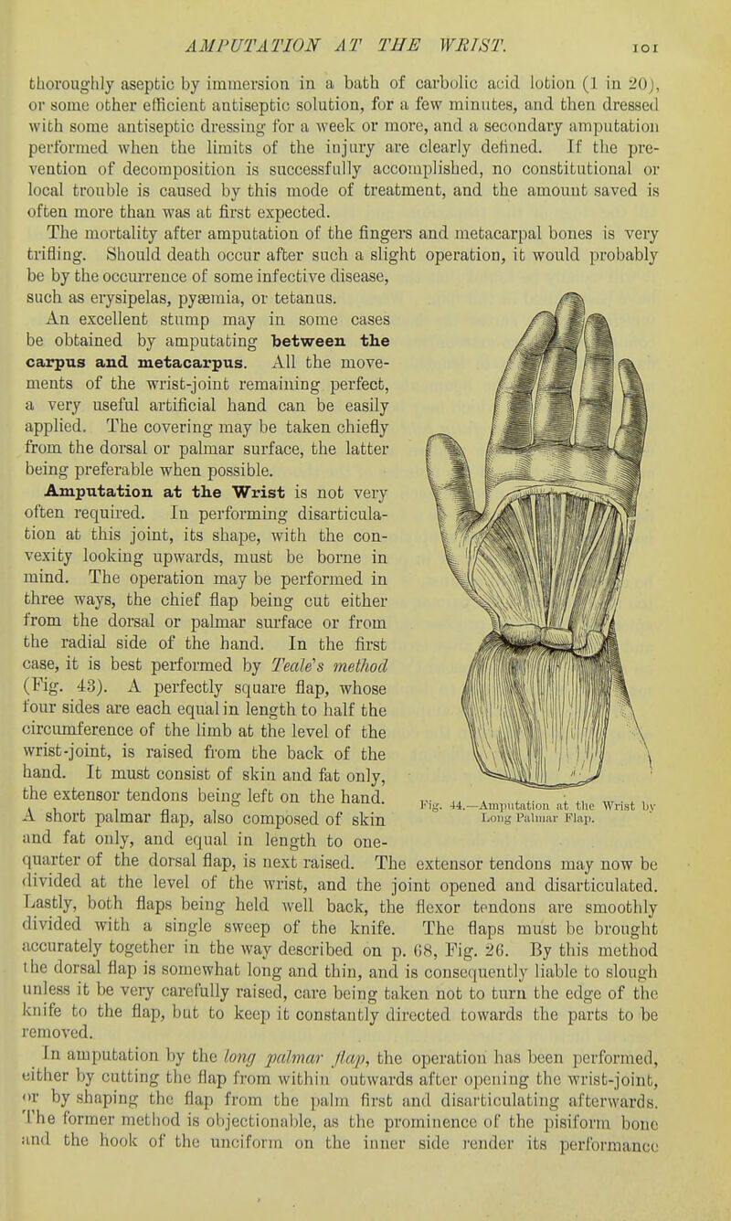 thoroughly aseptic by immersion in a bath of carbolic acid lotion (1 in 20J, or some other efficient antiseptic solution, for a few minutes, and then dressed with some antiseptic dressing for a week or more, and a secondary amputation performed when the limits of the injury are clearly defined. If the pre- vention of decomposition is successfully accomplished, no constitutional or local trouble is caused by this mode of treatment, and the amount saved is often more than was at first expected. The mortality after amputation of the fingers and metacarpal bones is very trifling. Should death occur after such a slight operation, it would probably be by the occurrence of some infective disease, such as erysipelas, pyaemia, or tetanus. An excellent stump may in some cases be obtained by amputating between the carpus and metacarpus. All the move- ments of the wrist-joint remaining perfect, a very useful artificial hand can be easily applied. The covering may be taken chiefly from the dorsal or palmar surface, the latter being preferable when possible. Amputation at the Wrist is not very often required. In performing disarticula- tion at this joint, its shape, with the con- vexity looking upwards, must be borne in mind. The operation may be performed in three ways, the chief flap being cut either from the dorsal or palmar surface or from the radial side of the hand. In the first case, it is best performed by Teale's method (Fig. 43). A perfectly square flap, whose four sides are each equal in length to half the circumference of the limb at the level of the wrist-joint, is raised from the back of the hand. It must consist of skin and fat only, the extensor tendons being left on the hand. A short palmar flap, also composed of skin and fat only, and equal in length to one- quarter of the dorsal flap, is next raised. The extensor tendons may now be divided at the level of the wrist, and the joint opened and disarticulated. Lastly, both flaps being held well back, the flexor tendons are smoothly divided with a single sweep of the knife. The flaps must be brought accurately together in the way described on p. 68, Fig. 26. By this method the dorsal flap is somewhat long and thin, and is consequently liable to slough unless it be very carefully raised, care being taken not to turn the edge of the knife to the flap, but to keep it constantly directed towards the parts to be removed. In amputation by the lo7irj palmar Jlap, the operation has been performed, either by cutting tlic flap from within outwards after opening the wrist-joint, <>r by shaping the flap from the palm first and disai-ticulating afterwards. 'I'he former nietiiod is objectionable, as the prominence of the pisiform bone iind the hook of the unciform on the inner side render its performance Fig. 44.—Ainimtation at tlic Wrist by Long Piiliuai' Flajj.