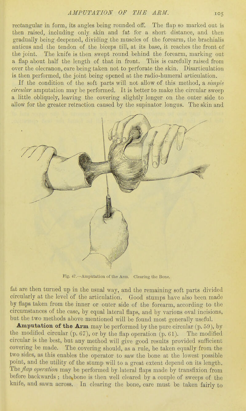 rectangular in form, its angles being rounded off. The flap so marked out is then raised, including only skin and fat for a short distance, and then gradually being deepened, dividing the muscles of the forearm, the brachialis anticus and the tendon of the biceps till, at its base, it reaches the front of the joint. The knife is then swept round behind the forearm, marking out a flap about half the length of that in front. This is carefully raised from over the olecranon, care being taken not to perforate the skin. Disarticulation is then performed, the joint being opened at the radio-humeral articulation. If the condition of the soft parts will not allow of this method, a simple circular amputation may be performed. It is better to make the circular sweep a little obliquely, leaving the covering slightly longer on the outer side to allow for the greater retraction caused by the supinator longus. The skin and Fig. 47.—Amputation of the Arm. Clearing tlic Bone. fat are then turned up in the usual way, and the remaining soft parts divided circularly at the level of the articulation. Good stumps have also been made by flaps taken from the inner or outer side of the forearm, according to the circumstances of the case, by equal lateral flaps, and by various oval incisions, but the two methods above mentioned will be found most generally useful. Amputation of the Arm may be performed by the pure circular (p. 59), by the modified circular (p. (JT), or by the flap operation (p. Gl). The modified circular is the best, but any method will give good results provided suflicient covering be made. The covering should, as a rule, be taken equally from the two sides, as this enables the operator to saw the bone at the lowest possible point, and the utility of the stump will to a great extent depend on its length. The flap operation may be performed by lateral flaps made by transfixion from before backwards ; the*bone is then M'ell cleared by a couple of sweeps of the knife, and sawn across. In clearing the bone, care must be taken fairly to