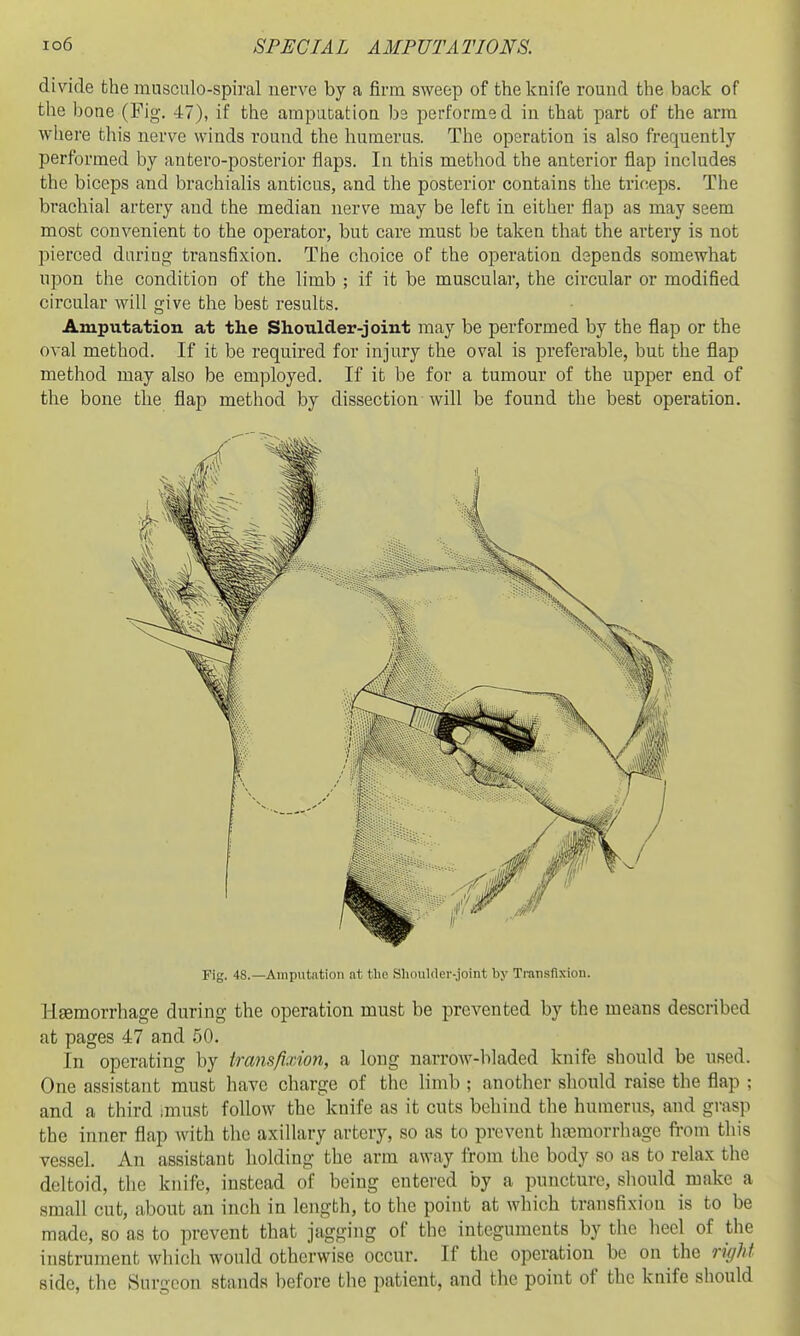 divide the musculo-spiral nerve by a firm sweep of the knife round the back of the bone (Fig. 47), if the ampabatioa bs performe d in that part of the arm where this nerve winds round the humerus. The operation is also frequently performed by antero-posterior flaps. In this method the anterior flap includes the biceps and brachialis anticus, and the posterior contains the triceps. The brachial artery and the median nerve may be left in either flap as may seem most convenient to the operator, but care must be taken that the artery is not pierced during transfixion. The choice of the operation depends somewhat upon the condition of the limb ; if it be muscular, the circular or modified circular will give the best results. Amputation at the Shoulder-joint may be performed by the flap or the oval method. If it be required for injury the oval is preferable, but the flap method may also be employed. If it be for a tumour of the upper end of the bone the flap method by dissection will be found the best operation. Fig. 48.—Amputation at tlic Slioulder-joint by Transfixion. Hsemorrhage during the operation must be prevented by the means described at pages 47 and 50. In operating by transfixion, a long narrow-bladed knife should be used. One assistant must have charge of the limb ; another should raise the flap ; and a third imust follow the knife as it cuts behind the humerus, and grasp the inner flap with the axillary artery, so as to prevent hjcmorrhage fi-om tliis vessel. An assistant holding the arm away from the body so as to relax the deltoid, the knife, instead of being entered by a puncture, should make a small cut, about an inch in length, to the point at which transfixion is to be made, so as to prevent that jagging of the integuments by the heel of the instrument which would otherwise occur. If tlie operation be on the right side, the Surgeon stands before the patient, and the point of the knife should