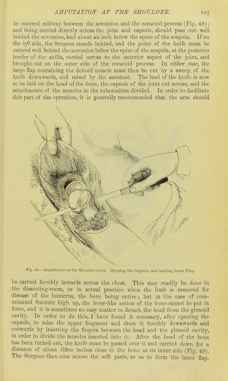 be entered midway between the acromion and the coracoid process (Fif;-. 48); and being carried directly across the joint and capsule, should pass, out well behind the acromion, and about an inch below the spine of the scapula. If on the left side, tlie Surgeon stands behind, and the point of the knife must be entered well behind the acromion below the spine of the scapula, at the posterior border of the axilla, carried across to the anterior aspect of the joint, and brought out on the outer side of the coracoid process. In either case, the large flap containing the deltoid muscle must then be cut by a sweep of the knife downwards, and raised by the assistant. The heel of the knife is now to be laid on the head of the bone, the capsule of the joint cut across, and the attachments of the muscles to the tuberosities, divided. In order to facilitate this part of the operation, it is generally recommended that the arm should Fig. 49—Amputation at the Shoulder-joint. Oiiening Hie Capsule, and making Inner Flap. be carried forcibly inwards across the chest. This may readily be done in the dissecting-room, or in actual practice when the limb is removed for disease of the humerus, the bone being entire ; but in the case of com- minuted fracture high up, the lever-like action of the bone cannot be put in force, and it is sometimes no easy matter to detach the head from the glenoid cavity. In order to do this, I have found it necessary, after opening the capsule, to seize the upper fragment and draw it forcibly downwards and outwards by inserting the fingers between the head and the glenoid cavity, in order to divide the muscles inserted into it. After the head of the bone has been turned out, the knife must be passed over it and carried down for a distance of about thVee inches close to the bone at its inner side (Fig. 49). The Surgeon then cuts across the soft parts, so as to form the inner flap.