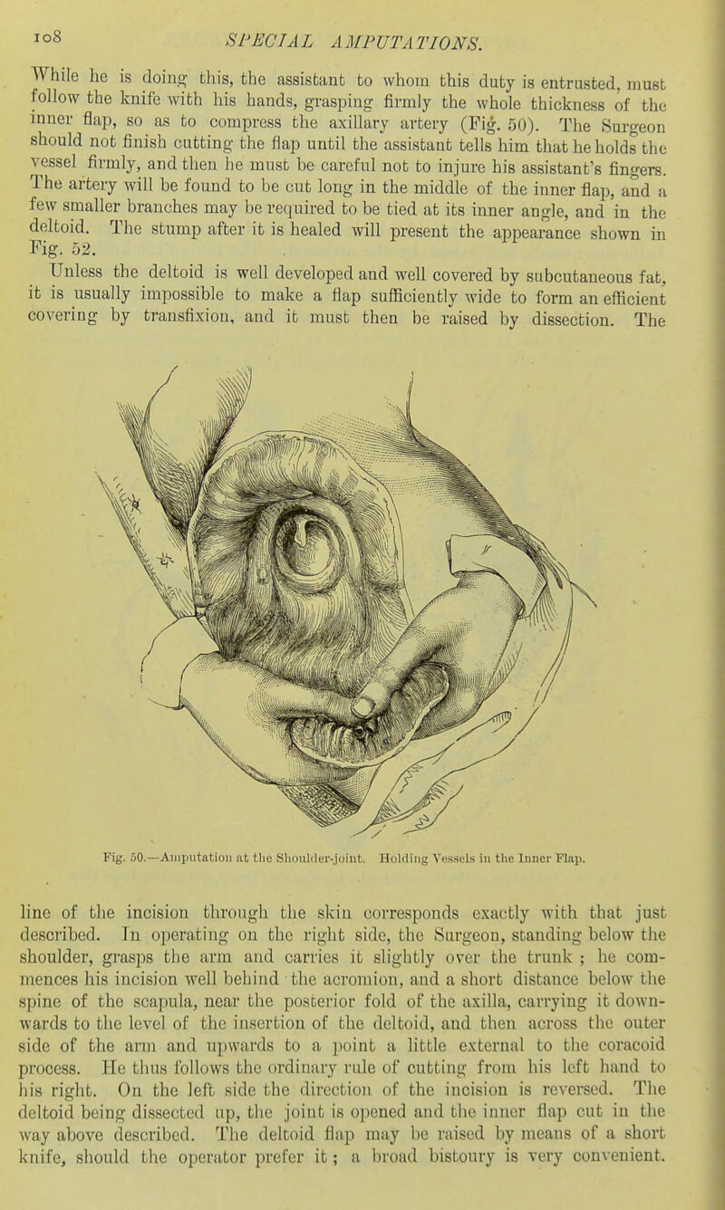 io8 While he is doins? this, the assistant to whom this duty is entrusted, must follow the knife with his hands, grasping firmly the whole thickness of the inner flap, so as to compress the axillary artery (Pig. 50). The Sm-geon should not finish cutting the flap until the assistant tells him that he holds the vessel firmly, and then he must be careful not to injure his assistant's fingers. The artery will be found to be cut long in the middle of the inner flap, and a few smaller branches may be required to be tied at its inner angle, and in the deltoid. The stump after it is healed will present the appearance shown in Fig. 52. Unless the deltoid is well developed and well covered by subcutaneous fat, it is usually impossible to make a flap sufficiently wide to form an efficient covering by transfixion, and it must then be raised by dissection. The Fig. 50.—Amputation at tlie Sliouliler-.ii)int. Holding Vessels in the Inner Flap. line of the incision through the skin corresponds exactly with that just described. Tn operating on the right side, the Surgeon, standing below the shoulder, grasps the arm and carries it slightly over the trunk ; he com- mences his incision well behind the acromion, and a short distance below the spine of the scapula, near the posterior fold of the axilla, carrying it down- wards to the level of the insertion of the deltoid, and then across the outer side of the arm and ujtwards to a jioint a little external to the coracoid process. He thus follows the ordinary rule of cutting from his left hand to his right. On the left side the direction of the incision is reversed. The deltoid being dissected up, the joint is opened and the inner flap cut in the way above described. The deltoid flap may be raised by means of a short knife, should the operator prefer it; a broad bistoury is very convenient.