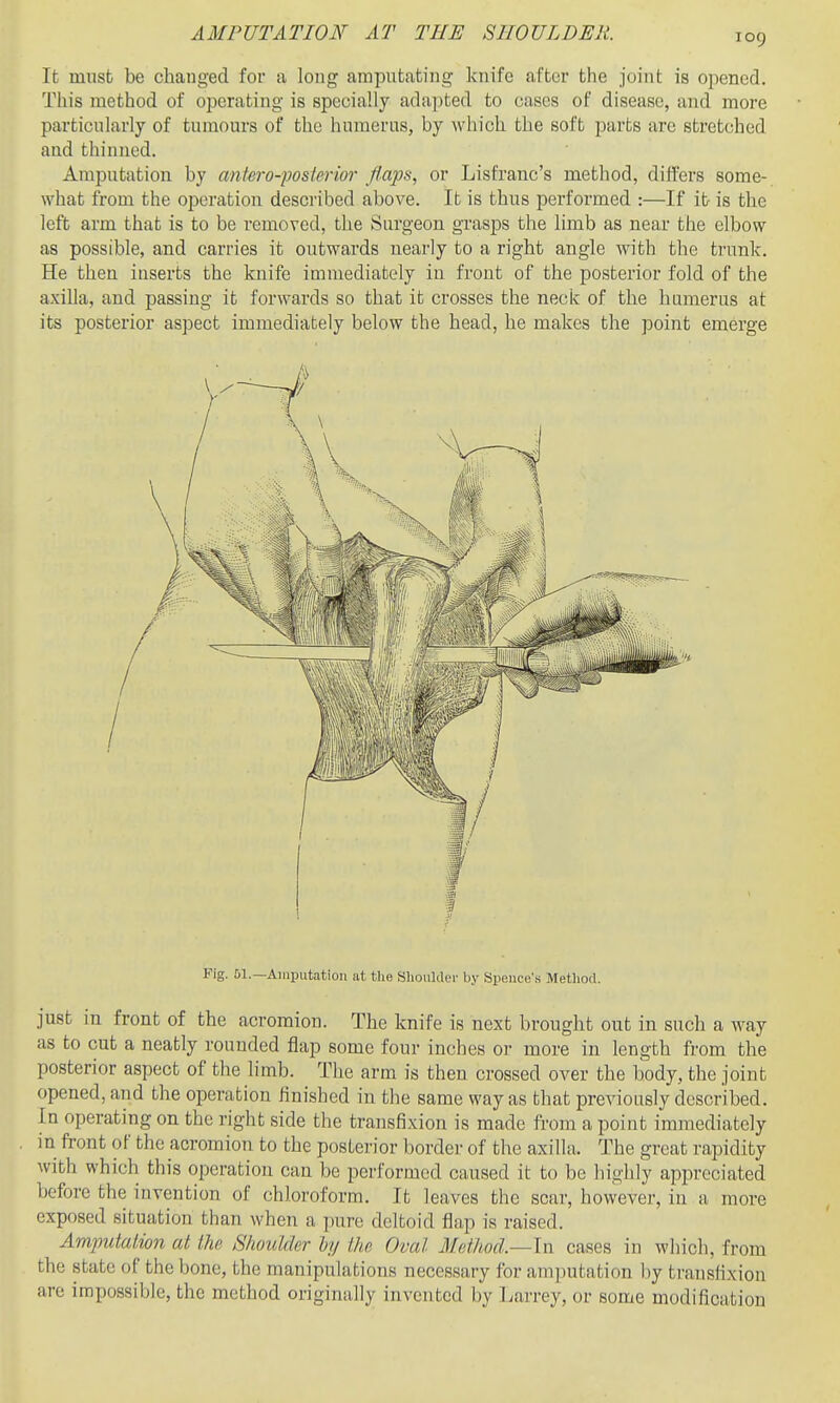 log It must be changed for a long amputating knife after the joint is opened. This method of operating is specially ada])ted to cases of disease, and more particularly of tumours of the humerus, by which the soft parts are stretched aad thinned. Amputation by antero-postcrior flaps, or Lisfranc's method, differs some- what from the operation described above. It is thus performed :—If it is the left arm that is to be removed, the Surgeon grasjjs the limb as near the elbow as possible, and carries it outwards nearly to a right angle with the trunk. He then inserts the knife immediately in front of the posterior fold of the axiUa, and passing it forwards so that it crosses the neck of the humerus at its posterior aspect immediately below the head, he makes the point emerge Fig. 51.—Aiuputatioii nt the Slioiilder by Speuce's Method. just in front of the acromion. The knife is next brought out in such a way as to cut a neatly rounded flap some four inches or more in length fi-om the posterior aspect of the limb. Tlie arm is then crossed over the body, the joint opened, and the operation finished in the same way as that previously described. In operating on the right side the transfixion is made from a point immediately in front of the acromion to the posterior border of the axilla. The great rapidity with which this operation can be performed caused it to be highly appreciated before the invention of chloroform. It leaves the scar, however, in a more exposed situation than when a ]mre deltoid flap is raised. Amjmtalion at ihp Shoulder hy the Oval Method—In cases in which, from the state of the bone, the manipulations necessary for amputation by transfixion are impossible, the method originally invented by Larrey, or some modification