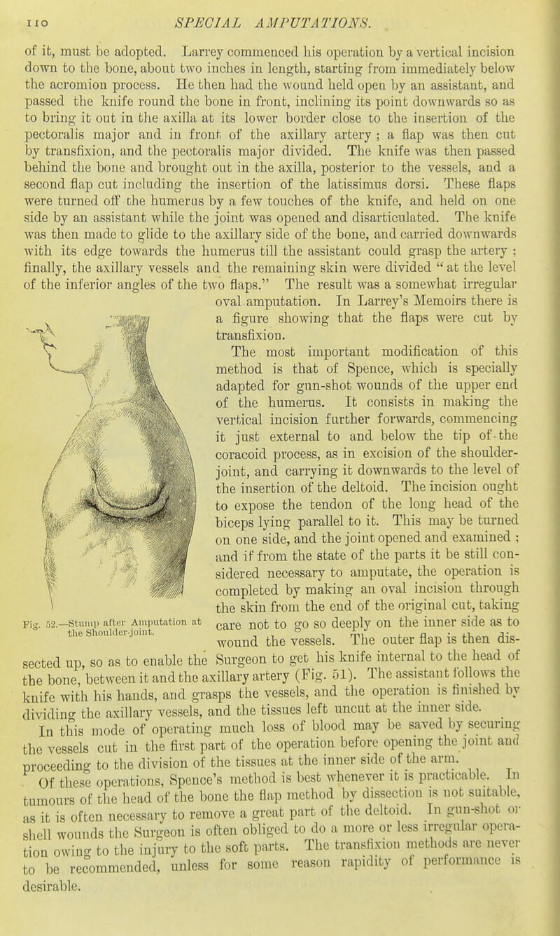 of it, must be adopted. Larrey commenced liis operation by a vertical incision down to tbe bone, about two inches in length, starting from immediately below the acromion process. He then had the wound held open by an assistant, and passed the knife round the bone in front, inclining its point downwards so as to bring it out in the axilla at its lovver border close to the insertion of the pectoralis major and in front of the axillary artery ; a flap was then cut by transfixion, and the pectoralis major divided. The knife Avas then passed behind the bone and brought out in the axilla, posterior to the vessels, and a second flap cut including the insertion of the latissimus dorsi. These flaps were turned oif the humerus by a few touches of the knife, and held on one side by an assistant while the joint was opened and disarticulated. The knife was then made to glide to the axillary side of the bone, and carried downwards with its edge towards the humerus till the assistant could grasp the artery : finally, the axillary vessels and the remaining skin were divided  at the level of the inferior angles of the two flaps. The result was a somewhat irregular oval amputation. In Larrey's Memoirs there is a figure showing that the flaps were cut by transfixion. The most important modification of this f : », method is that of Spence, which is specially adapted for gun-shot wounds of the upper end of the humerus. It consists in making the vertical incision farther forwards, commencing it just external to and below the tip of-the coracoid process, as in excision of the shoulder- joint, and carrying it downwards to the level of the insertion of the deltoid. The incision ought to expose the tendon of the long head of the biceps lying parallel to it. This may be turned on one side, and the joint opened and examined ; and i f from the state of the parts it be still con- sidered necessary to amputate, the operation is completed by making an oval incision through the skin from the end of the original cut, taking care not to go so deeply on the inner side as to wound the vessels. The outer flap is then dis- Suro-eon to get his knife internal to the head of the bone between it and the axillai-y artery^(Fig. 51). The assistant ibllows the knife with his hands, and grasps the vessels, and the operation is finished by dividino- the axillary vessels, and the tissues left uncut at the inner side. In this mode of operating much loss of blood may be saved by securmg the vessels cut in the first part of the operation before opening the joint and proceeding to the division of the tissues at the inner side of the arm. Of these operations, Spence's method is best whenever it is practicable. In tumours of the head of the bone the flap method by dissection is not suitable, as it is often necessary to remove a great part of the deltoid. In gun-shot or shell wounds the Surgeon is often obliged to do a more or less irregular opera- tion owing to the injury to the soft parts. The transfixion methods are never to be recommended, unless for some reason rapidity of performance is desirable. /// Fig. .52.- -Stuiiip after Amputation at the ShoiUder-joint. sected up, so as to enable the