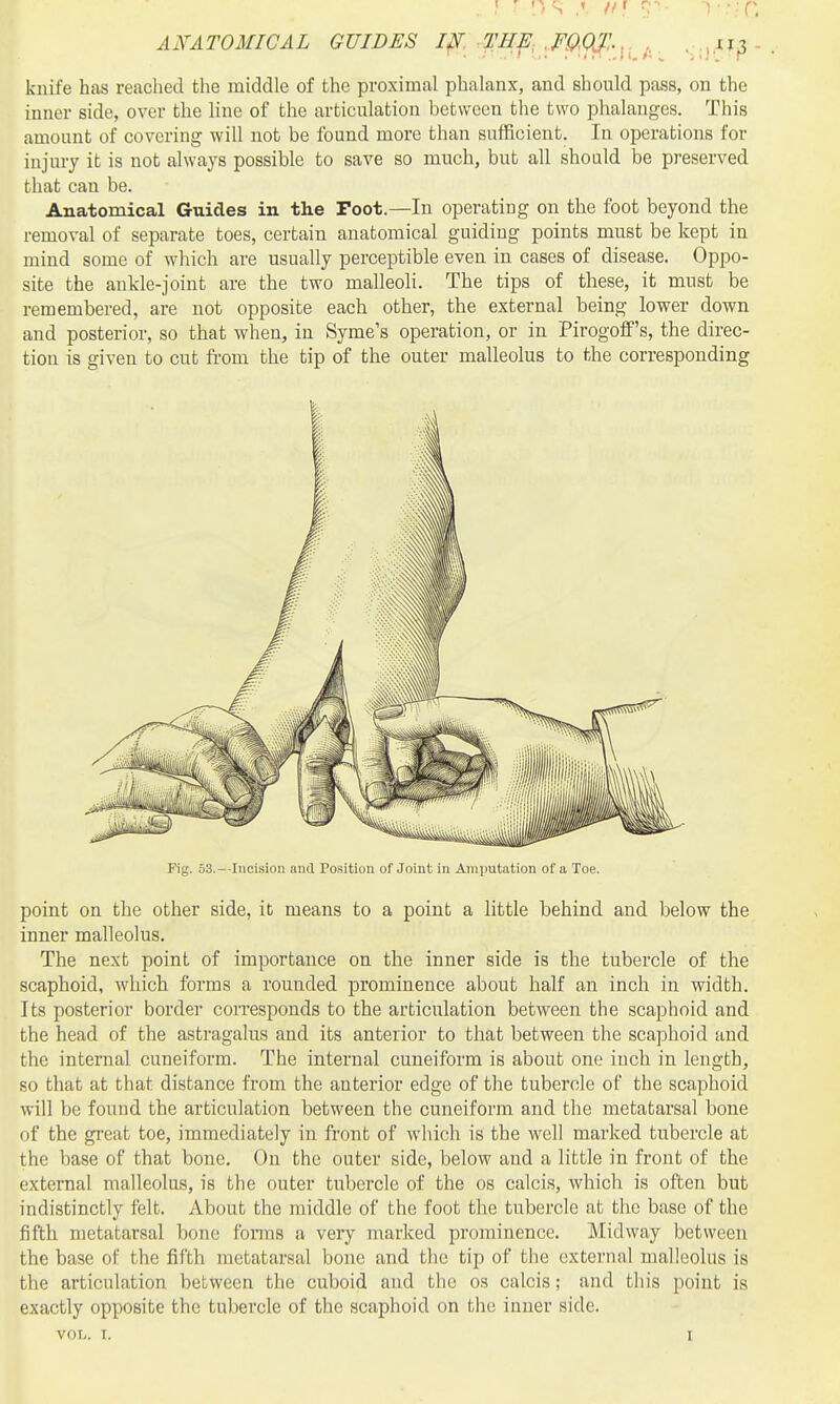 AiYATOMICAL GUIDES ipr^THf,.mQT.-,. knife has reached the middle of the proximal phalanx, and should pass, on the inner side, over the hne of the articulation between the two phalanges. This amount of covering will not be found more than sufficient. In operations for injury it is not always possible to save so much, but all should be preserved that can be. Anatomical Guides in the Toot.—In operating on the foot beyond the removal of separate toes, certain anatomical guiding points must be kept in mind some of which are usually perceptible even in cases of disease. Oppo- site the ankle-joint are the two malleoh. The tips of these, it must be remembered, are not opposite each other, the external being lower down and posterior, so that when, in Syme's operation, or in Pirogoff's, the direc- tion is given to cut from the tip of the outer malleolus to the corresponding point on the other side, it means to a point a little behind and below the inner malleolus. The next point of importance on the inner side is the tubercle of the scaphoid, which forms a rounded prominence about half an inch in width. Its posterior border corresponds to the articulation between the scaphoid and the head of the astragalus and its anterior to that between the scaphoid and the internal cuneiform. The internal cuneiform is about one inch in length, so that at that distance from the anterior edge of the tubercle of the scaphoid will be found the articulation between the cuneiform and the metatarsal bone of the great toe, immediately in front of which is the well marked tubercle at the base of that bone. On the outer side, below and a little in front of the external malleolus, is the outer tubercle of the os calcis, which is often but indistinctly felt. About the middle of the foot the tubercle at the base of the fifth metatarsal bone fonns a very marked prominence. Midway between the base of the fifth metatarsal bone and the tip of the external malleolus is the articulation between the cuboid and the os calcis; and this point is exactly opposite the tubercle of the scaphoid on the inner side. VOL. I. I Fig. 53.—Incision and Position of Joint in Amputation of a Toe.