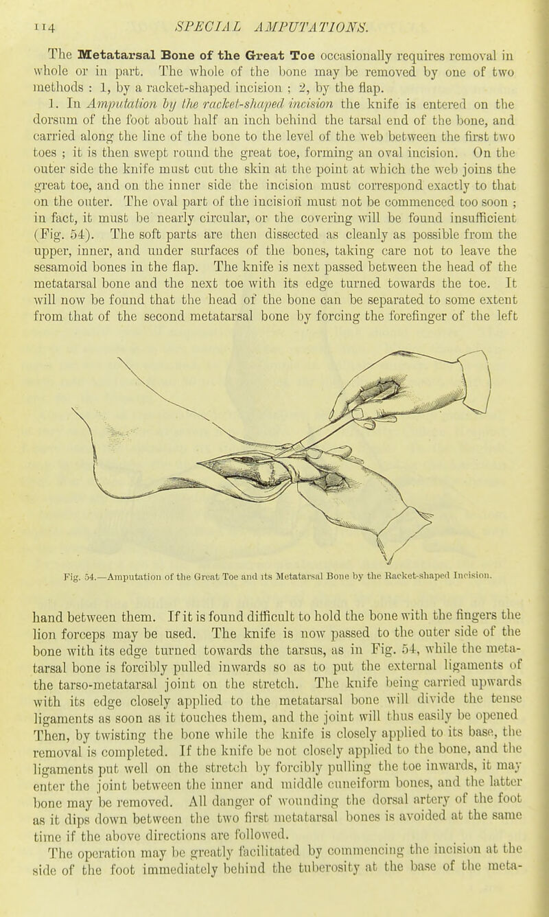 The Metatarsal Bone of the Great Toe occasionally requires removal in whole or in part. The whole of the bone may be removed by one of two methods : 1, by a racket-shaped hicieioii ; 2, by the flap. ]. In Amputation by the racJcet-shaped imision the knife is entered on the dorsum of the foot about half an inch behind the tarsal end of the bone, and carried along the line of the bone to the level of the web between the first two toes ; it is then swept round the great toe, forming- an oval incision. On the outer side the knife must cut the skin at the point at which the web joins the great toe, and on the inner side the incision must correspond exactly to that on the outer. The oval part of the incisioii must not be commenced too soon ; in fact, it must be nearly circular, or the covering will be found insufficient (Pig. 54). The soft parts are then dissected as cleanly as possible from the upper, inner, and under surfaces of the bones, taking care not to leave the sesamoid bones in the flap. The knife is next passed between the head of the metatarsal bone and the next toe with its edge turned towards the toe. It will now be found that the head of the bone can be separated to some extent from that of the second metatarsal bone by forcing the forefinger of the left Fig. 54.—Amputation of the Great Toe and its Metatarsal Bone by the Racket-shaped Incision. hand between them. If it is found difficult to hold the bone with the fingers the lion forceps may be used. The knife is now passed to the outer side of the bone with its edge turned towards the tarsus, as in Fig. 54, while the meta- tarsal bone is forcibly pulled inwards so as to put the external ligaments of the tarso-metatarsal joint on the stretch. The knife being carried upwards with its edge closely applied to the metatarsal bone will divide the tense ligaments as soon as it touches them, and the joint will thus easily be opened Then, by twisting the bone while the knife is closely applied to its base, the removal is completed. If the knife be not closely ap])licd to the bone, and the ligaments put well on the stretch by forcibly pulling the toe inwards, it may enter the joint between the inner and middle cuneiform bones, and the latter bone may be removed. All danger of wounding the dorsal artery of the foot as it dips down between the two first metatarsal bones is avoided at the same time if the above directions are followed. 'J'he operation may be greatly facilitated by commencing the incision at the side of the foot immediately behind the tuberosity at the base of the meta-