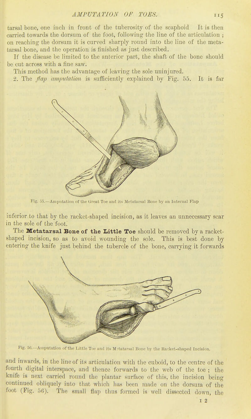 AMPUTATION OF TOES. tarsal bone, one inch in front of the tuberosity of the scaphoid It is then carried towards the dorsum of the foot, following the line of the articulation ; on reaching the dorsum it is curved sharply round into the line of the meta- tarsal bone, and the operation is finished as just described. If the disease be limited to the anterior part, the shaft of the bone should be cut across with a fine saw. This method has the advantage of leaving the sole uninjured. 2. The flap amputation is sufficiently explained by Fig. .55. It is far Fig. 55.—Amputation nf the Great Toe and its Jletatar.sal Bone by an Internal Flap inferior to that by the racket-shaped incision, as it leaves an unnecessary scar in the sole of the foot. The Metatarsal Bone of the Little Toe should be removed by a racket- shaped incision, so as to avoid wounding the sole. This is best done by entering the knife just behind the tubercle of the bone, carrying it forwards Fig. 5IJ.—Amputation of the Little Toe and its M ■tatavsal Honi; liy the Kncket-sliaped Incision, and inwards, in the line of its articulation with the cuboid, to the centre of the fourtli digital interspace, and thence forwards to the web of the toe ; the knife is next carried round the plantar surface of this, the incision being continued obliquely into that which has been made on the dorsum of the foot (Fig. no). The small fla]i tluis formed is well dissected down, the I 2