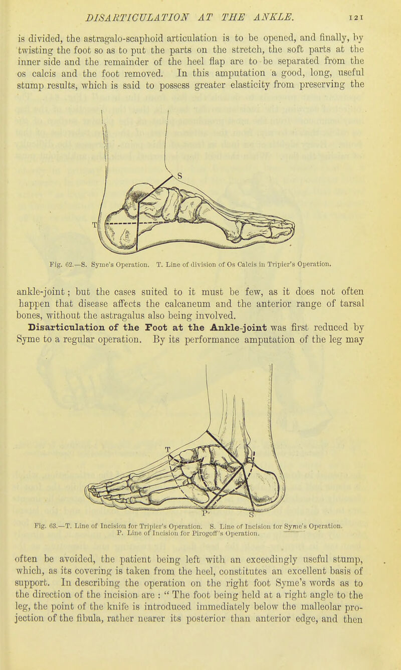 is divided, the astragalo-scaphoid articulation is to be opened, and finally, by twisting the foot so as to put the parts on the stretch, the soft parts at the inner side and the remainder of the heel flap arc to be separated from the OS calcis and the foot removed. In this amputation a good, long, useful stump results, which is said to possess greater elasticity from preserving the Fig. 62.—S. Syme's Operation. T. Line of (livi.sion of Os Calcis in Tripier's Operation. ankle-joint; but the cases suited to it must be few, as it does not often happen that disease affects the calcaneum and the anterior range of tarsal bones, without the astragalus also being involved. Disarticulation of the Foot at the Ankle-joint was first reduced by Syme to a regular operation. By its performance amputation of the leg may Fig. 63.—T. Line of Incision for Tripier's Operation. S. Line of Incision for Syme's Operation. P. Line of Incision for Pirogoff's Operation. often be avoided, the patient being left with an exceedingly useful stump, ■which, as its covering is taken from the heel, constitutes an excellent basis of support. In describing the operation on the right foot Syme's words as to the direction of the incision are :  The foot being held at a right angle to the leg, the point of the kniie is introduced immediately below the malleolar pro- jection of the fibula, rather nearer its posterior than anterior edge, and then