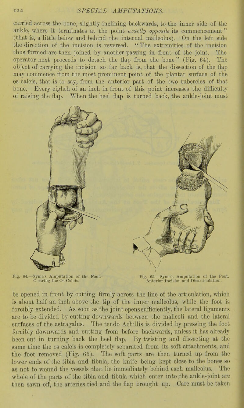 carried across the bone, slightly inclining backwards, to the inner side of the ankle, whei'e it terminates at the point exactly opposite its commencement (that is, a little below and behind the internal malleolus). On the left side the direction of the incision is reversed. The extremities of the incision thus formed are then joined by another passing in front of the joint. The operator next proceeds to detach the flap from the bone (Fig. 64). The object of carrying the incision so far back is, that the dissection of the flap may commence from the most prominent point of the plantar surface of the OS calcis, that is to say, from the anterior part of the two tubercles of that bone. Every eighth of an inch in front of this point increases the difliculty of raising the flap. When the heel flap is turned back, the ankle-joint must Fig. G4.—Syme's Ainimtatioii of the Foot. Fig. 05.—Syine's Amputation of tlie Foot. Clearing the O.s Calcis, Anterior Incision and Disarticulation. be opened in front by cutting firmly across the line of the articulation, which is about half an inch above the tip of the inner malleolus, while the foot is forcibly extended. As soon as the joint opens sufficiently, the lateral ligaments are to be divided by cutting downwards between the malleoli and the lateral surfaces of the astragalus. The tendo Achillis is divided by pressing the foot forcibly downwards and cutting from before backwards, unless it has already been cut in turning back the heel flap. By twisting and dissecting at the same time the os calcis is completely separated from its soft attachments, and the foot removed (Fig, 65). The soft parts arc then turned up from the lower ends of the tibia and fibula, the knife being kept close to the bones so as not to wound the vessels that lie immediately behind each malleolus. The whole of the parts of the tibia and fibula which enter into the ankle-joint are then sawn off, the arteries tied and the flap brought up. Care must be taken