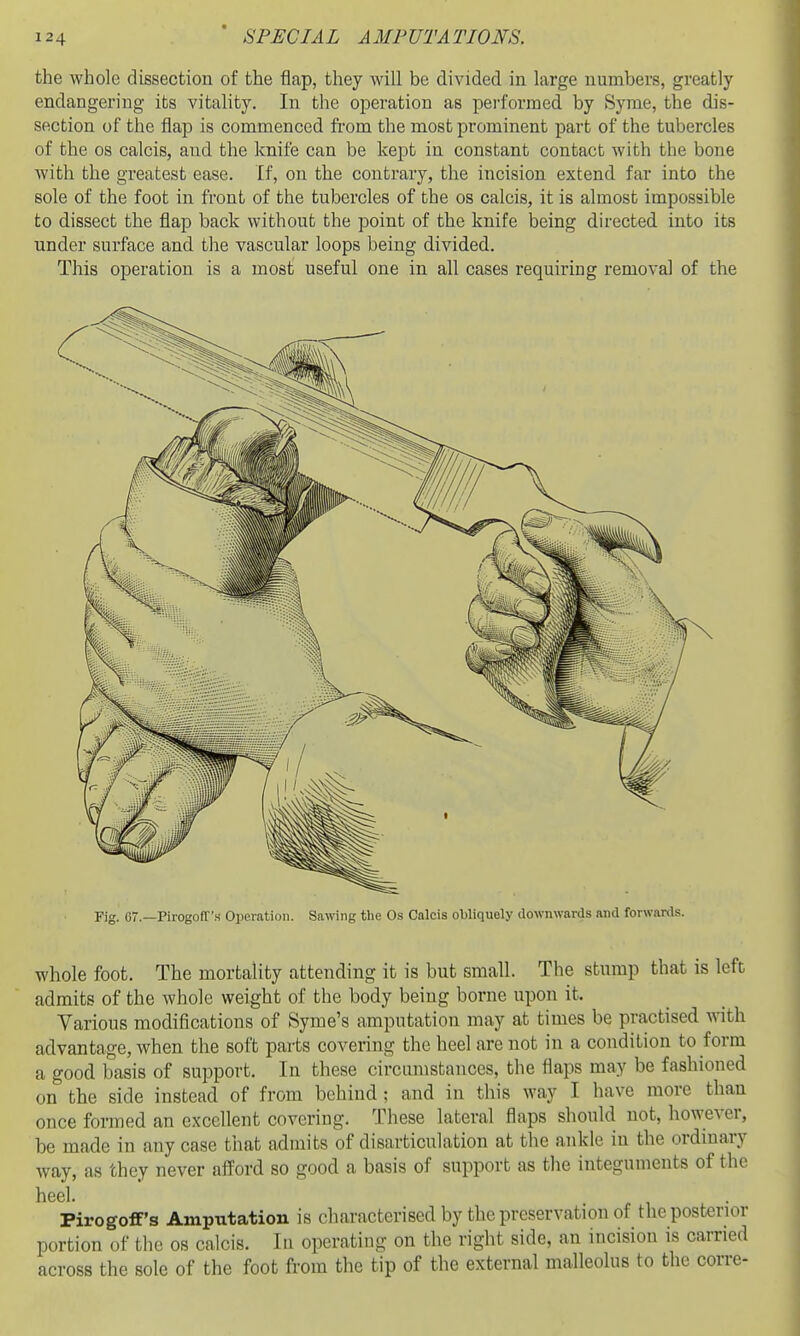 the whole dissection of the flap, they will be divided in large numbers, greatly endangering its vitality. In the operation as pei'formed by Syme, the dis- section of the flap is commenced fi-om the most prominent part of the tubercles of the OS calcis, and the knife can be kept in constant contact with the bone with the greatest ease. If, on the contrary, the incision extend far into the sole of the foot in front of the tubercles of the os calcis, it is almost impossible to dissect the flap back without the point of the knife being directed into its under surface and the vascular loops being divided. This operation is a most useful one in all cases requiring removal of the Fig. 67.—Pirogoff's Operation. Sawing the Os Calcis obliquely downwards and forwards. whole foot. The mortality attending it is but small. The stump that is left admits of the whole weight of the body being borne upon it. Various modifications of Syme's amputation may at times be practised with advantage, when the soft parts covering the heel are not in a condition to form a good basis of support. In these circumstances, the flaps may be fashioned on the side instead of from behind : and in this way I have more than once formed an excellent covering. These lateral flaps should not, however, be made in any case that admits of disarticulation at the ankle in the ordinary way, as they never afford so good a basis of support as the integuments of the heel. Pirogoff's Amputation is characterised by the preservation of the posterior portion of tlie os calcis. In operating on the right side, an incision is carried across the sole of the foot from the tip of the external malleolus to the corre-