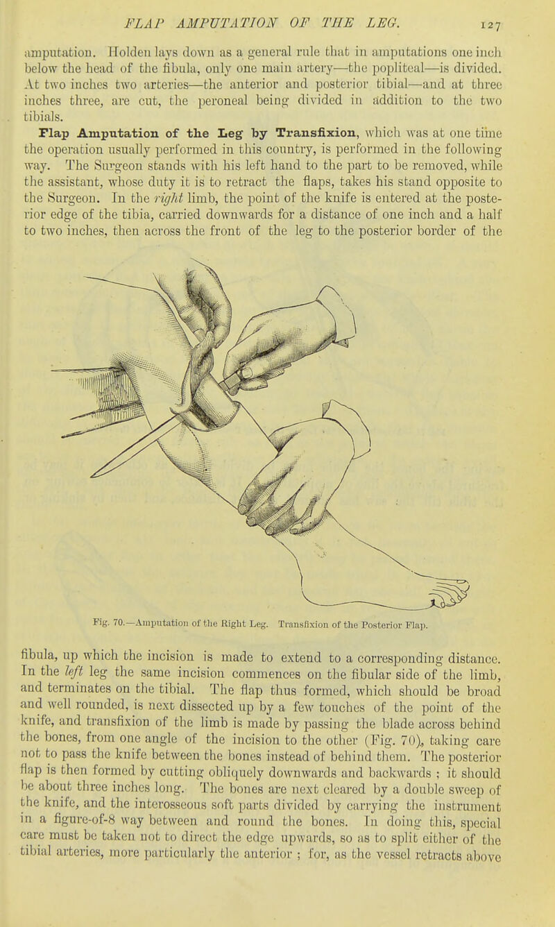FLAP AMPUTATION OF THE LEG. amputation. Holdeii lays down as a general rule that in anipntations one inch below the head of the fibula, only one main artery—the popliteal—is divided. At two inches two arteries—the anterior and posterior tibial—and at three inches three, are cut, the peroneal being divided in addition to the two tibials. riap Amputation of the Leg by Transfixion, which was at one tiine the operation usually perlbrmed in this country, is performed in the following way. The Surgeon stands w'ith his left hand to the part to be removed, while the assistant, whose duty it is to retract the flaps, takes his stand opposite to the Surgeon. In the right limb, the point of the knife is entered at the poste- rior edge of the tibia, carried downwards for a distance of one inch and a half to two inches, then across the front of the leg to the posterior border of the Fig. 70.—Amputation of the Right Leg. Transfixion of the Posterior Flap. fibula, up which the incision is made to extend to a corresponding distance. In the left leg the same incision commences on the fibular side of the limb, and terminates on the tibial. The flap thus formed, which should be broad and well rounded, is next dissected up by a few touches of the point of the knife, and transfixion of the limb is made by passing the blade across behind the bones, from one angle of the incision to the other (Fig. 70)^ taking care not to pass the knife between the bones instead of behind them. The posterior flap is then formed by cutting obliquely downwards and backwards ; it should be about three inches long. The bones are next cleared by a double sweep of the knife, and the interosseous soft parts divided by carrying the instrument m a figure-of-8 way between and round the bones. In doing this, special care must be taken not to direct the edge upwards, so as to split either of the tibial arteries, more particularly the anterior ; for, as the vessel retracts above