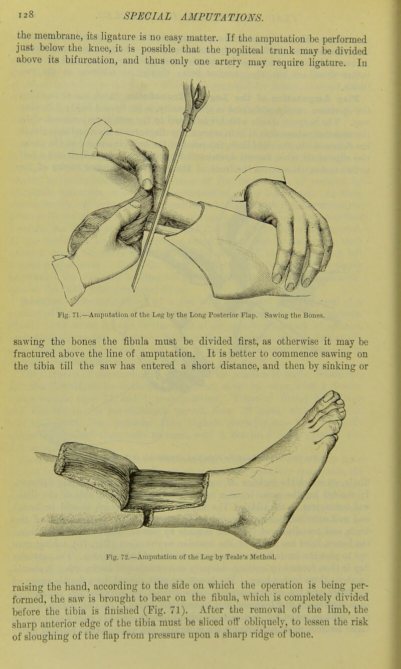 the membrane, its ligatm-e is no easy matter. If the amputation be performed just below the knee, it is possible that the pophteal trunk may divided above its bifurcation, and thus only one artery may require ligature. In Fig. 71.—Aminitatiou of the Leg by the Long Posterior Flap. Sawng the Bone.s, sawing the bones the fibula must be divided first, as otherwise it may be fractured above the line of amputation. It is better to commence sawing on the tibia till the saw has entered a short distance, and then by sinking or Fig. 72.—Amputation of the Log by Teale'.s Motliml. raising the hand, according to the side on which the operation is being per- formed, the saw is brought to bear on the fibula, whicii is completely divided before the tibia is finished (Fig. 71). After the removal of the limb, the sharp anterior edge of the tibia must be sliced off obliquely, to lessen the risk of sloughing of the flap from pressure upon a sharp ridge of bone.