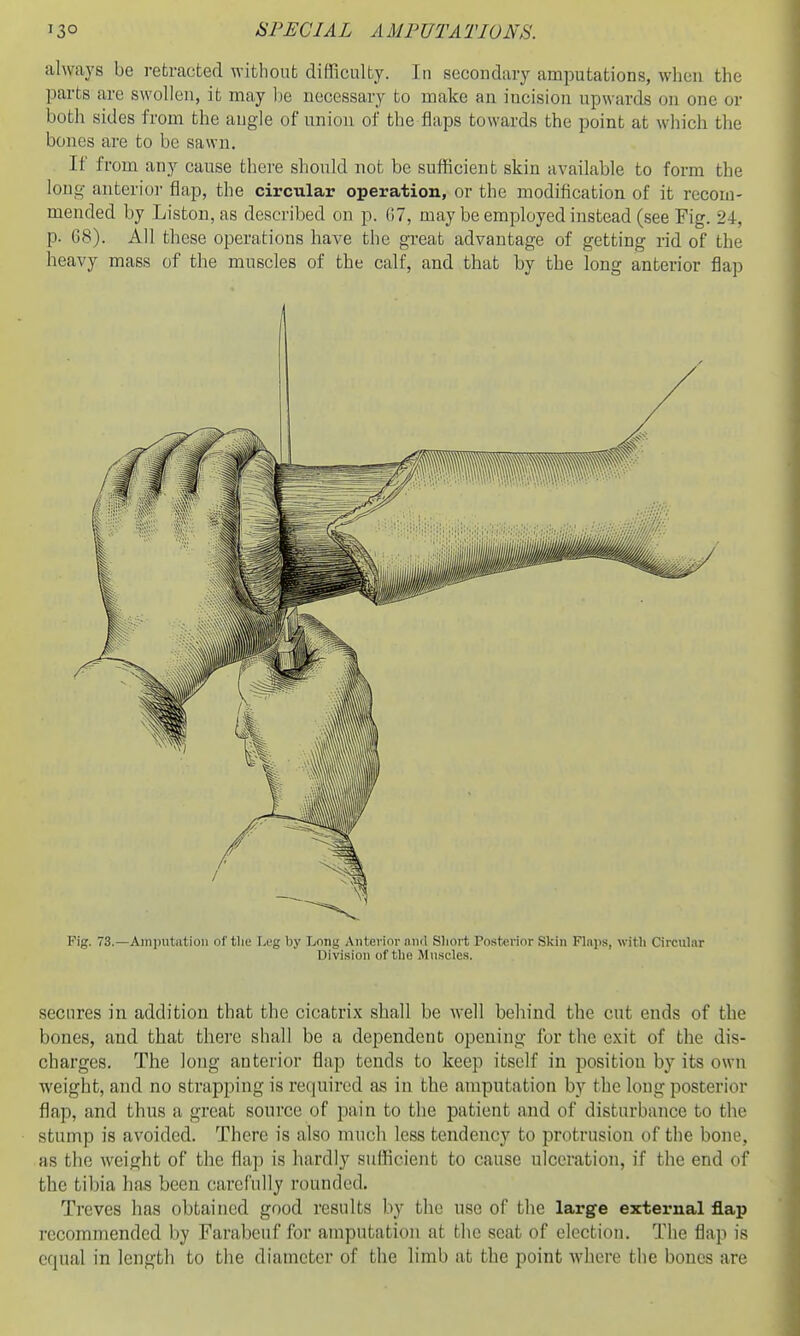 always be retracted without difficulty. In secondary amputation.s, when the parts are swollen, it may lie necessary to make an incision upwards on one or both sides from the angle of union of the flaps towards the point at which the bones are to be sawn. If from any cause there should not be sufficient skin available to form the long anterio]' flap, the circular operation, or the modification of it recom- mended by Listen, as described on p. 07, may be employed instead (see Fig. 24, p. G8). All these operations have the great advantage of getting rid of the heavy mass of the muscles of the calf, and that by the long anterior flap Fig. 73.—Amputation of tlie Leg by Long Anterior inul Short Posterior Skin Flaps, with Circular Division of the Muscles. secures in addition that the cicatrix shall be well behind the cut ends of the bones, and that there shall be a dependent opening for the exit of the dis- charges. The long anterior flap tends to keep itself in position by its own weight, and no strapping is retjuired as in the amputation by the long posterior flap, and thus a great source of pain to the patient and of disturbance to the stump is avoided. There is also much less tendency to protrusion of the bone, as the weight of the flap is hardly sufficient to cause ulceration, if the end of the tibia has been carefully rounded. Treves has obtained good results by the use of the large external flap recommended by Farabeuf for amputation at the seat of election. The flap is equal in length to the diameter of the limb at the point where the bones are