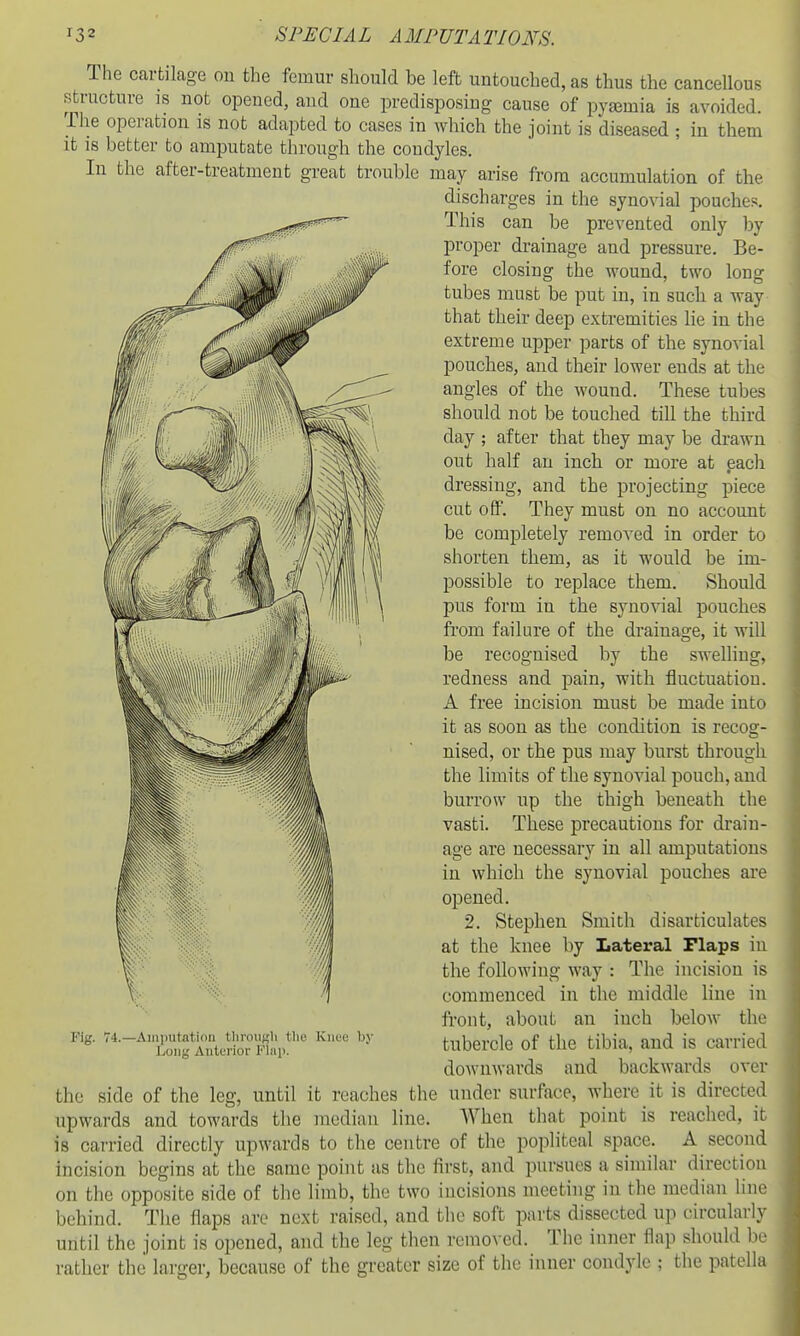 The cartilage on the femur should be left untouched, as thus the cancellous structure is not opened, and one predisposing cause of pyaemia is avoided. The operation is not adapted to cases in which the joint is diseased ; in them it is better to amputate through the condyles. In the after-treatment great trouble may arise from accumulation of the discharges in the synovial pouches. This can be prevented only by proper drainage and pressure. Be- fore closing the wound, two long tubes must be put in, in such a way that their deep extremities he in the extreme upper parts of the synovial pouches, and their lower ends at the angles of the wound. These tubes should not be touched till the third day ; after that they may be drawn out half an inch or more at .each dressing, and the projecting piece cut off. They must on no account be completely removed in order to shorten them, as it would be im- possible to replace them. Should pus form in the synovial pouches fi'om failure of the drainage, it will be recognised by the swelling, redness and pain, with fluctuation. A free incision must be made into it as soon as the condition is recog- nised, or the pus may burst through the limits of the synovial pouch, and burrow up the thigh beneath the vasti. These precautions for drain- age are necessary in all amputations in which the synovial pouches are opened. 2. Stephen Smith disarticulates at the knee by Lateral Flaps in the following way : The incision is commenced in the middle line in front, about an inch below the tubercle of the tibia, and is carried downwards and backwards over the side of the leg, until it reaches the under surface, where it is directed upwards and towards the median line. When that point is reached, it is carried directly upwards to the centre of the popliteal space. A second incision begins at the same point as the first, and pursues a similar direction on the opposite side of the limb, the two incisions meeting in the median liiu' behind. The flaps are next raised, and the soft parts dissected up circular!}- until the joint is opened, and the leg then removed. The inner flap should W rather the larger, because of the greater size of the inner condyle ; the patella Fig. 74.—Aiiiimtation tlinnisli llie Knee by Long Anturior Flap.