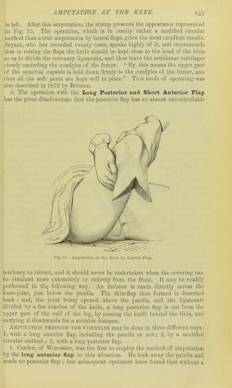 is left. After this amputation, the stump presents the a]Dpearance represented in Fig. 75. The operation, which is in reality rather a modified circular method than a true amputation by lateral flaps, gives the most excellent results. Bryant, who has recorded twenty cases, speaks highly of it, and recommends that in raising the flaps the knife should be kept close to the head of the tibia so as to divide the coronary ligaments, and thus leave the semilunar cartilages closely encircling the condyles of the femur.  By this means the upper part of the synovial capsule is held down firmly to the condyles of the femur, ana thus all the soft parts are kept well in place. This mode of operating was also described in 1872 by Brinton. 3. The operation with the Long Posterior and Short Anterior Flap has the great disadvantage that the posterior flap has an almost uncontrollable - Fig. 75.—Amputation at tlie Knee by Lateral Flap. tendency to retract, and it should never be undertaken when the covering can be obtained more extensively or entirely from the front. It may be readily performed in thg following way. An incision is made directly across the knee-joint, just below the patella. The skin-flap thus formed is dissected back ; and, the joint being opened above the patella, and the ligaments divided by a few touches of the knife, a long posterior flap is cut from the upper part of the calf of the leg, by passing the knife behind the tibia, and carrying it doAvnwards for a suitable distance. Amputation through the Condyles maybe done in three different ways: 1, with a long anterior flap, including the patella or not; 2, by a modified circular method ; 3, with a long posterior flap. 1. Garden, of Worcester, was the first to employ the method of amputation by the long anterior flap in this situation. Ife took away the patella and made no posterior flap ; but subsequent operators have found that without a