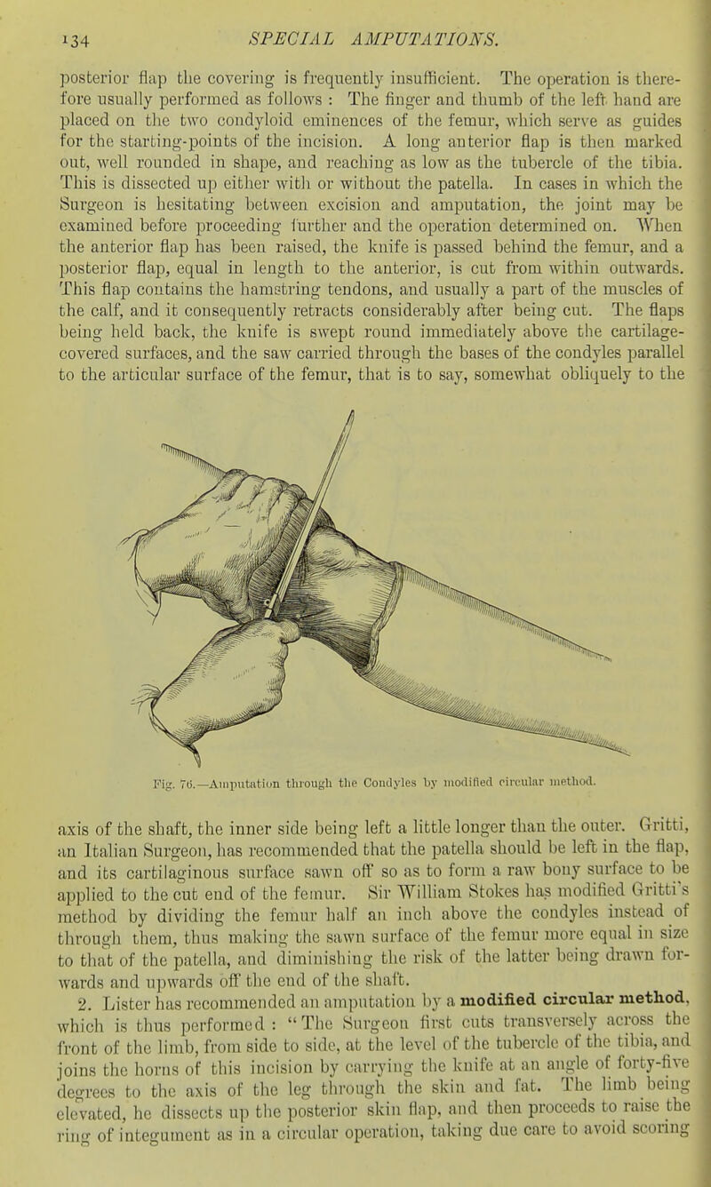 posterior flap the covering is frequently insufficient. The operation is there- fore usually performed as follows : The finger and thumb of the left hand are placed on the two condyloid eminences of the femur, which serve as guides for the starting-points of the incision. A long anterior flap is then marked out, well rounded in shape, and reaching as low as the tubercle of the tibia. This is dissected up either with or without the patella. In cases in which the Surgeon is hesitating between excision and amputation, the joint may be examined before proceeding iurther and the operation determined on. AV'hen the anterior flap has been raised, the knife is passed behind the femur, and a posterior flap, equal in length to the anterior, is cut from within outwards. This flap contains the hamstring tendons, and usually a part of the muscles of the calf, and it consequently retracts considerably after being cut. The flaps being held back, the knife is swept round immediately above the cartilage- covered surfaces, and the saw carried through the bases of the condyles parallel to the articular surface of the femur, that is to say, somewhat obliquely to the Fig. 7i5.—Amputation tlii'ough tlie Comlyles by modified rirt-ular method. axis of the shaft, the inner side being left a little longer than the outer. Gritti, an Italian Surgeon, has recommended that the patella should he left in the flap, and its cartilaginous surface sawn off so as to fornr a raw bony surface to be applied to the cut end of the femur. Sir William Stokes has modified Gritti's method by dividing the femur half an inch above the condyles instead of througli them, thus making the sawn surface of the femur more equal in size to that of the patella, and diminishing the risk of the latter being drawn for- wards and upwards off the end of the shaft. 2. Lister has recommended an amputation by a modified circular method, which is thus performed: The Surgeon first cuts transversely across the front of the limb, from side to side, at the level of the tubercle of the tibia, and joins the horns of this incision by carrying the knife at an angle of forty-five degrees to the axis of the leg through the skin and fat. The limb being elev'ated, he dissects up the posterior skin flap, and then proceeds to raise the i-ing of integument as in a circular operation, taking due care to avoid scoring