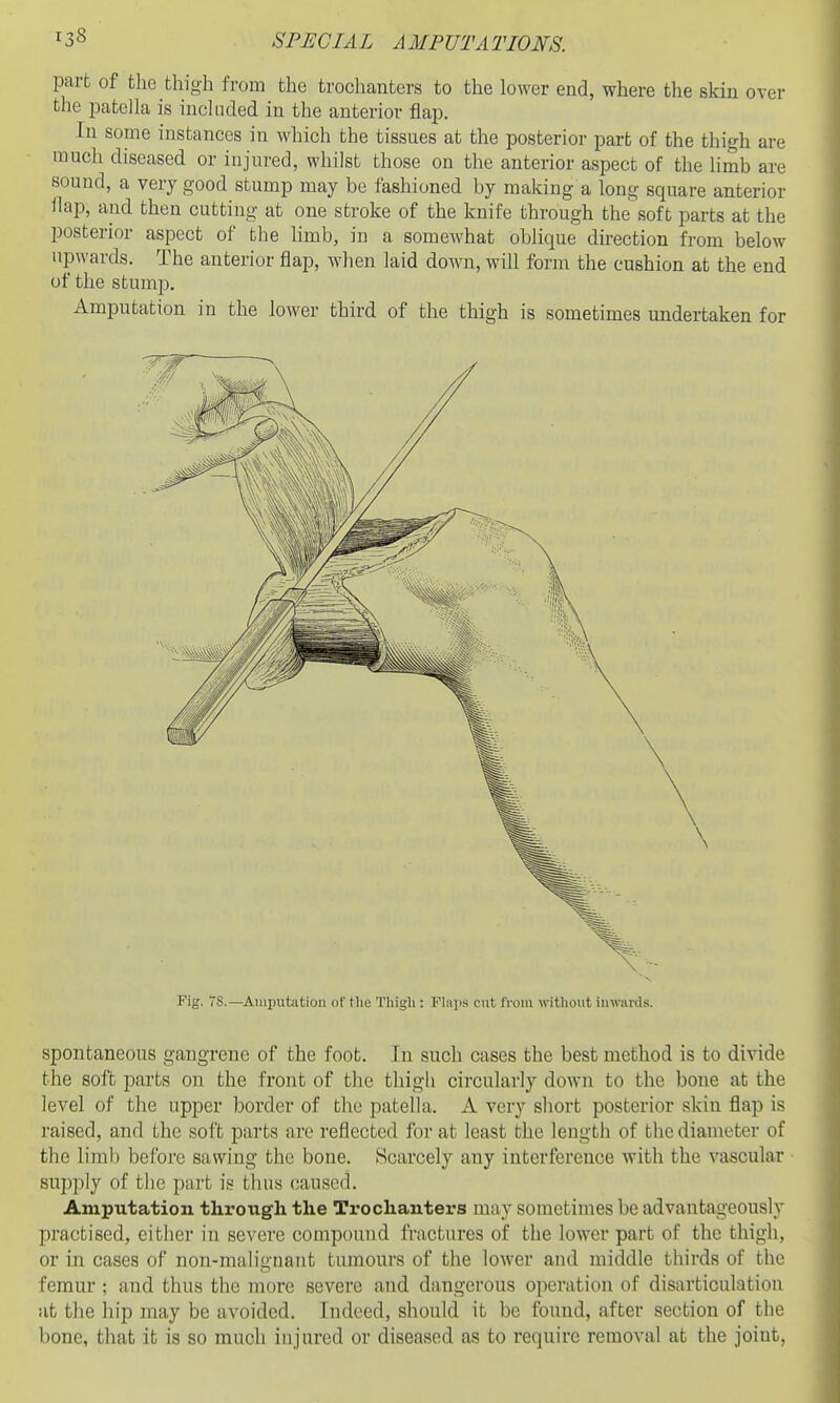 part of the thigh from the trochanters to the lower end, where the skin over the patella is included in the anterior flap. In some instances in which the tissues at the posterior part of the thigh are much diseased or injured, whilst those on the anterior aspect of the limb are sound, a very good stump may be fashioned by making a long square anterior flap, and then cutting at one stroke of the knife through the soft parts at the posterior aspect of the limb, in a somewhat oblique direction from below upwards. The anterior flap, when laid down, will form the cushion at the end of the stump. Amputation in the lower third of the thigh is sometimes undertaken for spontaneous gangrene of the foot. In sucli cases the best method is to divide the soft parts on the front of the thigli circularly down to the bone at the level of the upper border of the patella. A very short posterior skin flap is raised, and the soft parts are reflected for at least the length of the diameter of the limb before sawing the bone. Scarcely any interference with the vascular supply of the part is thus caused. Amputation through the Trochanters may sometimes be advantageously practised, cither in severe compound fractures of the lower part of the thigh, or in cases of non-malignant tumours of the lower and middle thirds of the femur ; and thus the more severe and dangerous operation of disarticulation at the hip may be avoided. Indeed, should it be found, after section of the bone, that it is so much injured or diseased as to require removal at the joint,