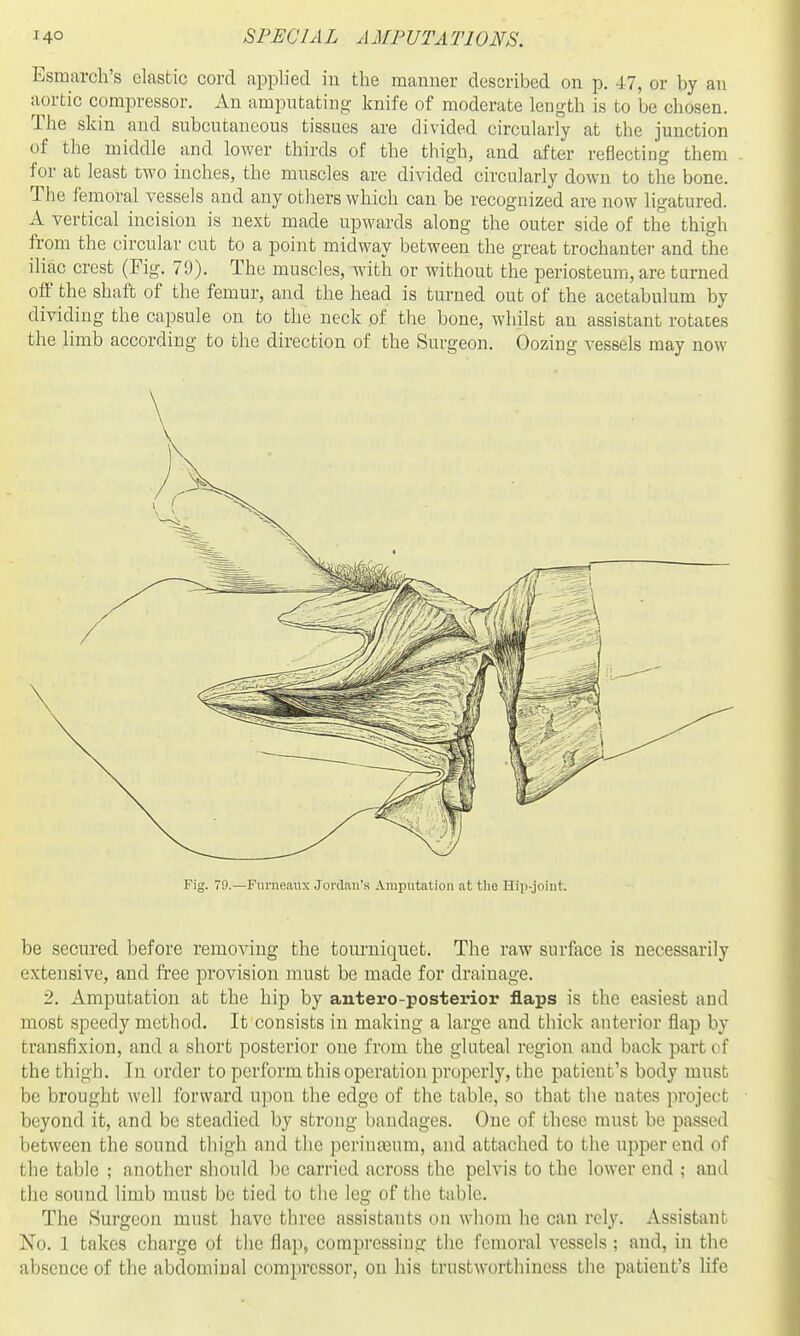 Esmarcli's elastic cord applied in the manner described on p. 47, or by an aortic compressor. An amputating- knife of moderate length is to be chosen. The skin and subcutaneous tissues are divided circularly at the junction of the middle and lower thirds of the thigh, and after reflecting them for at least two inches, the muscles are divided circularly down to the bone. The femoral vessels and any others which can be recognized are now ligatured. A vertical incision is next made upwards along the outer side of the thigh from the circular cut to a point midway between the great trochanter and the iliac crest (Fig. 79). The muscles, with or without the periosteum, are turned off the shaft of the femur, and the head is turned out of the acetabulum by dividing the capsule on to the neck of the bone, whilst an assistant rotates the limb according to the direction of the Surgeon. Oozing vessels may now Fig. 79.—Furneaiix Jordan's Amputation at tlie Hiii-joint be secured before removing the tom-niquet. The raw surface is necessarily extensive, and free provision must be made for drainage. 2. Amputation at the hip by antero-posterior flaps is the easiest and most speedy method. It consists in making a large and thick anterior flap by transfixion, and a short posterior one from the gluteal region and back part of the thigh. In order to perform this operation properly, the patient's body must be brought well forward upon the edge of the table, so that the nates project beyond it, and be steadied by strong bandages. One of these must be passed between the sound thigli and the perinteum, and attached to the upper end of the table ; another should be carried across the pelvis to the lower end ; and the sound limb must be tied to the leg of the table. The 8urgeon must have three assistants on whom he can rely. Assistant No. 1 takes charge of the flap, coraprcssiug the femoral vessels ; and, in the absence of the abdominal compressor, on his trustworthiness the patient's life