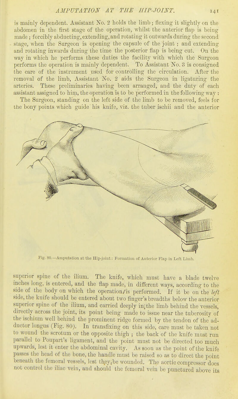 is maiuly dependent. Assistant No. 2 holds the limb; flexing it slightly on the abdomen in the first stage of the operation, whilst the anterior fla]i is being made ; forcibly abdncting, extending,and rotating it outwai'ds during the second stage, when the Surgeon is opening the capsule of the joint ; and extending and rotating inwards during the time the posterior flap is being cut. On the way in which he performs these duties the facility with which the Surgeon performs the operation is mainly dependent. To Assistant No. 3 is consigned the care of the instrument used for controlling the circulation. After the removal of the limb. Assistant No. 2 aids the Surgeon in ligaturing the arteries. These preliminaries having been arranged, and the duty of each assistant assigned to him, the operation is to be performed in the following way : The Surgeon, standing on the left side of the limb to be removed, feels for the bony points which guide his knife, viz. the tuber ischii and the anterior Fig. SO.—Amputation at the Hip-.joint: Formation of Anterior Flap in Left Limb. superior spine of the ilium. The knife, which must have a blade twelve inches long, is entered, and the flap made, in different ways, according to the side of the body on which the operation/is performed. If it be on the left side, the knife should be entered about two finger's breadths below the anterior superior spine of the ilium, and carried deeply in; the limb behind the vessels, directly across the joint, its point being made to issue near the tuberosity of the ischium well behind the prominent ridge formed by the tendon of the ad- ductor longus (Fig. 80). In transfixing on this side, care must be taken not to wound the scrotum or the opposite thigh ; the back of the knife must run parallel to Poupart's ligament, and the point must not be directed too much upwards, lest it enter the abdominal cavity. As soon as the point of the knife passes the head of the bone, the handle must be raised so as to direct the point beneath the femoral vessels, lest tlT,cy5be wounded. The aortic compressor does not control the iliac vein, and should the femoral vein be punctured above its