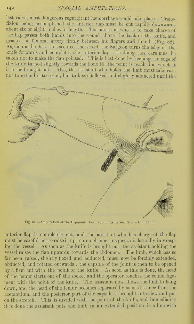 last valve, most clangorous regurgitant hemorrhage would take place. Trans- fixion being accomplished, the anterior flap must be cut rapidly downwards about six or eight inches iu length. The assistant who is to take charge of the flap passes both hands into the wound above the back of the kuife, and grasps the femoral arterj firmly between his fingers and thumbs (Fig. 82). As^soon as he has thus secured the vessel, tlie Surgeon turns the edge of the knife forwards and completes the anterior flap. In doing this, care must be taken not to make the flap pointed. This is best done by keeping the edge of the kuife turned slightly towards the bone till the point is reached at which it is to be brought out. Also, the assistant who holds the limb must take care not to extend it too soon, but to keep it flexed and slightly adducted until the Fig. SI.—Amputation at the Hip-joint: Foiiiiation of Anterior Flap in Right Limb. anterior flap is completely cut, and the assistant who has charge of the flap must be careful not to raise it up too mucli nor to squeeze it laterally in grasp- ing the vessel. As soon as the knife is brought out, the assistant holding the vessel raises the flap upwards towards the abdomen. The limb, which has so far been raised, slightly flexed and adducted, must now be forcibly extended, abducted, and rotated outwards ; the capsule of the joint is then to be opened by a firm cut with the point of the kuife. As soon as this is done, the head of the femur starts out of the socket and the operator touches the round liga- ment with the point of the knife. The assistant now allows the limb to hang down, and the head of the femur becomes separated by some distance from the acetabulum, and the posterior part of the capsule is brought into view and put on the stretch. This is divided with the point of the knife, and immediately it is done the assistant puts the limb in an extended position in a line with