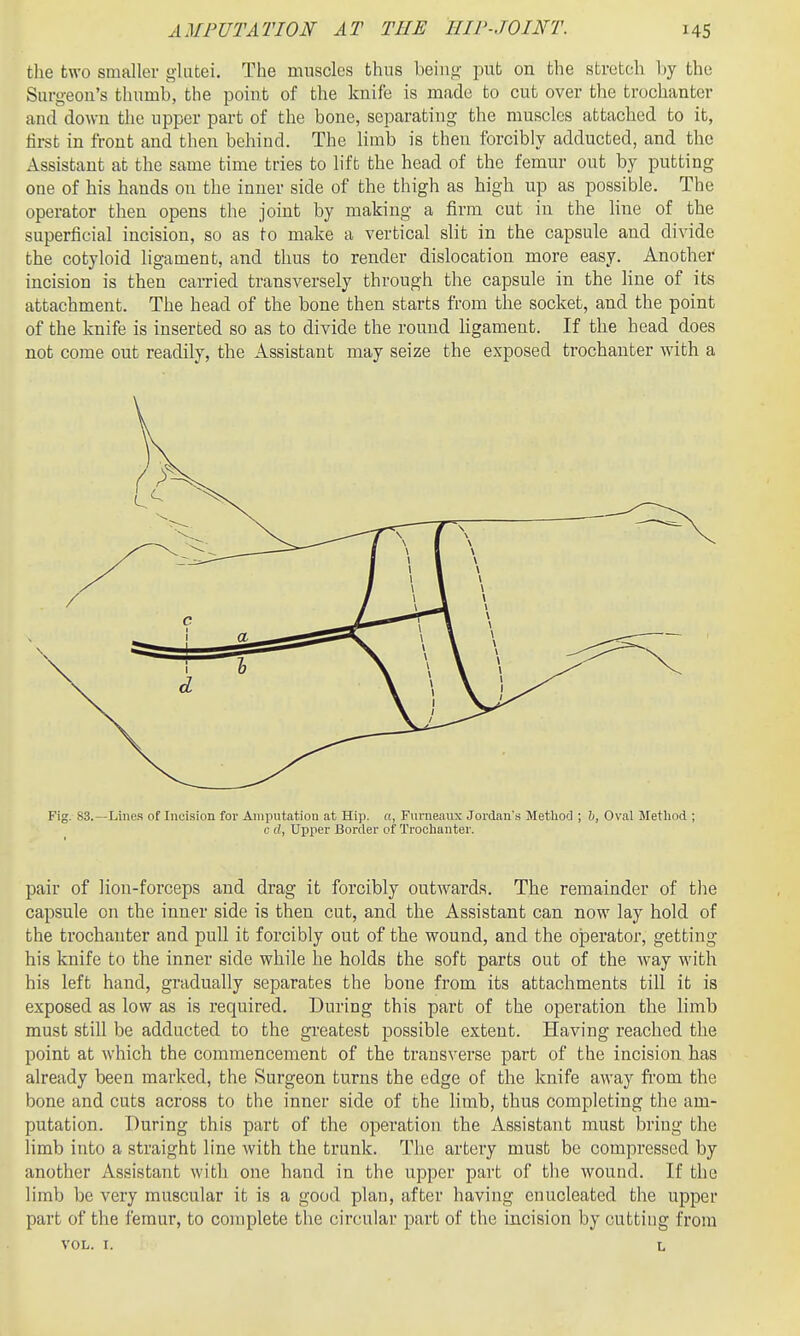 the two smaller glutei. The muscles thus being put on the stretch by the Surgeon's thumb, the point of the knife is made to cut over the trochanter and down the upper part of the bone, separating the muscles attached to it, first in front and then behind. The limb is then forcibly adducted, and the Assistant at the same time tries to lift the head of the femur out by putting one of his hands on the inner side of the thigh as high up as possible. The operator then opens the joint by making a firm cut in the hue of the superficial incision, so as to make a vertical slit in the capsule and divide the cotyloid ligament, and thus to render dislocation more easy. Another incision is then carried transversely through the capsule in the line of its attachment. The head of the bone then starts from the socket, and the point of the knife is inserted so as to divide the round ligament. If the head does not come out readily, the Assistant may seize the exposed trochanter with a Fig. 83.—Lines of Incision fov Amputation at Hip. a, Furneaux Jordan's MetliorJ ; h, Oval Method ; c d. Upper Border of Trochanter. pair of lion-forceps and drag it forcibly outwards. The remainder of the capsule on the inner side is then cut, and the Assistant can now lay hold of the trochanter and pull it forcibly out of the wound, and the operator, getting his knife to the inner side while he holds the soft parts out of the way with his left hand, gradually separates the bone from its attachments till it is exposed as low as is required. During this part of the operation the limb must still be adducted to the greatest possible extent. Having reached the point at which the commencement of the transverse part of the incision has already been marked, the Surgeon turns the edge of the knife away from the bone and cuts across to the inner side of the limb, thus completing the am- putation. During this part of the operation the Assistant must bring the limb into a straight line with the trunk. The artery must be compressed by another Assistant with one hand in the upper part of the wound. If the limb be very muscular it is a good plan, after having enucleated the upper part of the i'emur, to complete the circular part of the incision by cutting from VOL. I. L