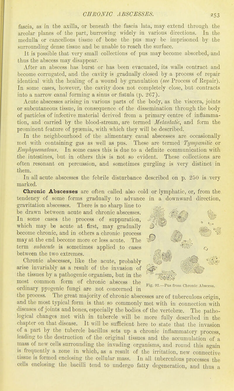 CHRONIC ABSCESSES. fascia, as in the axilla, or beneath the fascia lata, may extend through the areolar planes of the part, burrowing widely in various directions. In the medulla or cancellous tissue of bone the pus may be imprisoned by the surrounding dense tissue and be unable to reach the surface. It is possible that very small collections of pus may become absorbed, and thus the abscess may disappear. After an abscess has burst or has been evacuated, its walls contract and become corrugated, and the cavity is gradually closed by a process of repair identical with the healing of a wound by granulation {see Process of Repair), In some cases, however, the cavity does not completely close, but contracts into a narrow canal forming a sinus or fistula (p. 267). Acute abscesses arising in various parts of the body, as the viscera, joints or subcutaneous tissue, in consequence of the dissemination through the body of particles of infective material derived from a primary centre of inflamma- tion, and carried by the blood-stream, are tenned Metastatic, and form the prominent feature of pyasmia, with which they will be described. In the neighbourhood of the alimentary canal abscesses are occasionally met with containing gas as well as pus. These are termed Tym]]anitic or Eiiqyhysematous. In some cases this is due to a definite communication with the intestines, but in others this is not so evident. These collections are often resonant on percussion, and sometimes gurgling is very distinct in them. In all acute abscesses the febrile disturbance described on p. 250 is very marked. Chronic ATjscesses are often called also cold or lymphatic, or, from the tendency of some forms gradually to advance in a downward direction, gravitation abscesses. There is no sharp line to be drawn between acute and chronic abscesses. In some cases the process of suppuration, which may be acute at first, may gradually become chronic, and in others a chronic process may at the end become more or less acute. The term subacute is sometimes applied to cases between the two extremes. Chronic abscesses, like the acute, probably arise invariably as a result of the invasion of the tissues by a pathogenic organism, but in the most common form of chronic abscess the ordinary pyogenic fungi are not concerned in the process. The great majority of chronic abscesses are of tuberculous origin, and the most typical form is that so commonly met with in connection with diseases of joints and bones, especially the bodies of the vertebrjB. The patho- logical changes met with in tubercle will be more fully described in the chapter on that disease. It will be sufficient here to state that the invasion of a part by the tubercle bacillus sets up a chronic inflammatory process, leading to the destruction of the original tissues and the accumulation of a mass of new cells surrounding the invading organisms, and round tliis again is frequently a zone in which, as a result of the irritation, new connec^tive tissue is formed enclosing the cellular mass. In all tuberculous processes the cells enclosing the bacilli tend to undergo fatty degeneration, and thus a •.■<>'::'?M.' Fig. !)2.—Pus from Chronic Abscess.