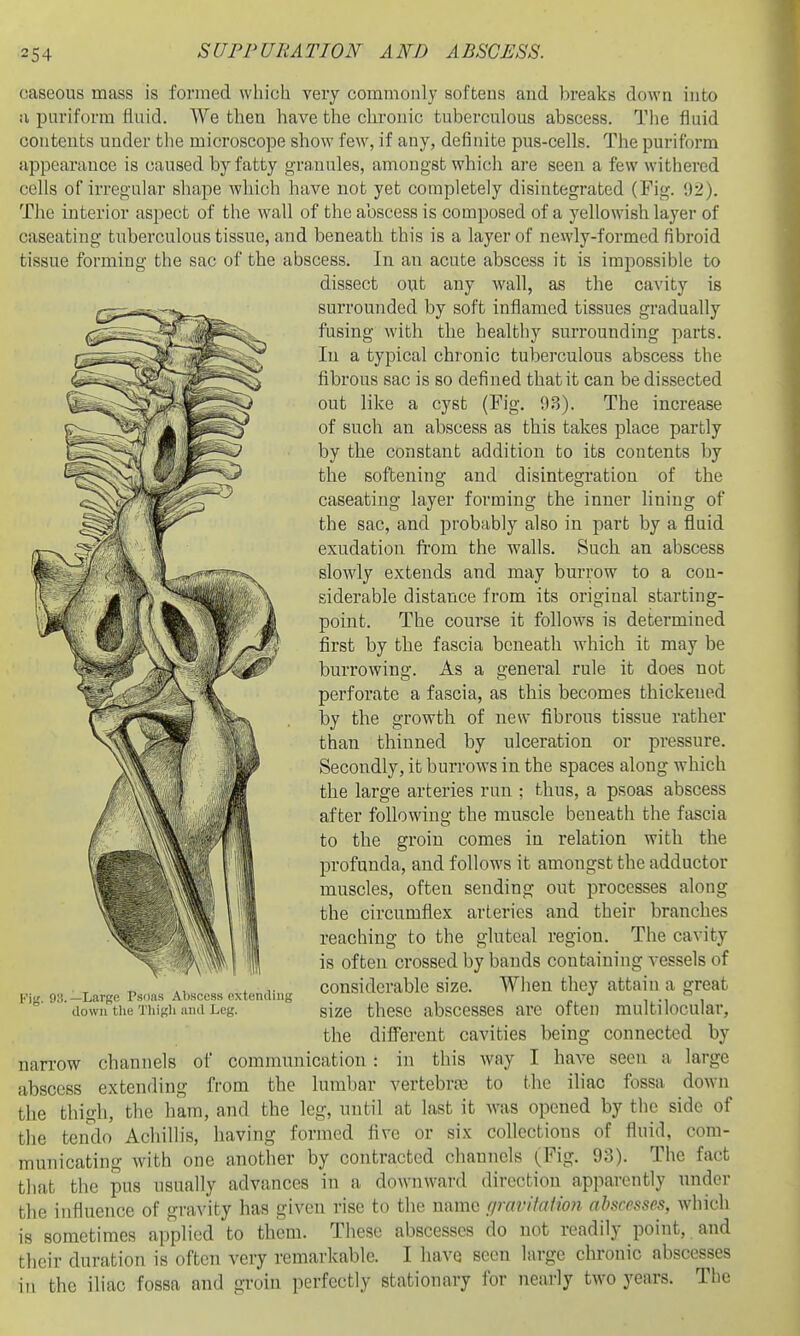 caseous mass is formed which very commonly softens and breaks down into ;i puriform fluid. We then have the chronic tuberculous abscess. The fluid contents under the microscope show few, if any, definite pus-cells. The puriform appearance is caused by fatty granules, amongst which are seen a few withered cells of irregular shape which have not yet completely disintegrated (Fig. 92). The interior aspect of the wall of the abscess is composed of a yellowish layer of caseating tuberculous tissue, and beneath this is a layer of newly-formed fibroid tissue forming the sac of the abscess. In an acute abscess it is impossible to dissect out any wall, as the cavity is surrounded by soft inflamed tissues gradually fusing with the healthy surrounding parts. In a typical chronic tuberculous abscess the fibrous sac is so defined that it can be dissected out like a cyst (Fig. 93). The increase of such an abscess as this takes place partly by the constant addition to its contents by the softening and disintegration of the caseating layer forming the inner lining of the sac, and probably also in part by a fluid exudation fi-oni the walls. Such an abscess slowly extends and may burrow to a con- siderable distance from its original starting- point. The course it follows is determined first by the fascia beneath which it may be burrowing. As a general rule it does not perforate a fascia, as this becomes thickened by the growth of new fibrous tissue rather than thinned by ulceration or pressure. Secondly, it burrows in the spaces along which the large arteries run ; thus, a psoas abscess after following the muscle beneath the fascia to the groin comes in relation with the profunda, and follows it amongst the adductor muscles, often sending out processes along the circumflex arteries and their branches reaching to the gluteal region. The cavity is often crossed by bands containing vessels of considerable size. When they attain a great size these abscesses are often multilocular, the diflFereut cavities being connected by narrow channels of communication: in this way I have seen a large abscess extending from the lumbar vertebrae to the iliac fossa down the thigh, the ham, and the leg, until at last it was opened by the side of tlie tendo Acliillis, having formed five or six collections of fluid, com- municating with one another by contracted channels (Fig. 93). The fact that the pus usually advances in a downward direction apparently under the influence of gravity has given rise to the name (jravitaiion abscesses, which is sometimes applied to them. These abscesses do not readily point, and their duration is often very remarkable. I have seen I'M.', o:! —Large Psoas Abscess extending down the Thigli anil Leg. large chronic abscesses m the iliac fossa and groin perfectly stationary ibr nearly two years. The