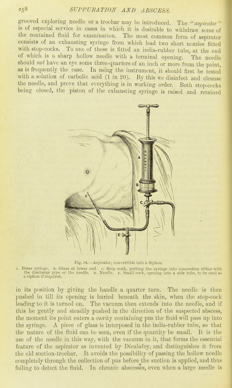 grooved exploring needle or a trochar may be introduced. The ''aspirator is of especial service in cases in which it is desirable to withdraw some of the contained fluid for examination. The most common form of aspirator consists of an exhausting syringe from which lead two short nozzles fitted with stop-cocks. To one of these is fitted an india-rubber tube, at the end of which is a sharp hollow needle with a terminal opening. The needle should not have an eye some three-qnarters of an inch or more from the point, as is frequently the case. In using the instrument, it should first be tested with a solution of carbolic acid (1 in 20). By this we disinfect and cleanse the needle, and prove that everything is in working order. Both stop-cocks being closed, the piston of the exhausting syringe is raised and retained Fig. 94.—Aspirator, convertible into a Siphon. A. Brass .syringe, b. Gla.ss at lower end. c. Stop cock, putting the syringe into connection either witli the discharge pipe or the needle, d. Needle, n. Small cork, opening into a side tube, to be used as a siphon if required. in its position by giving the handle a quarter turn. The needle is then pushed in till its opening is buried beneath the skin, when the stop-cock leading to it is turned on. The vacuum then extends into the needle, and if this be gently and steadily pushed in the direction of the suspected abscess, the moment its point enters a cavity containing pus the fluid will pass up into the syringe. A piece of glass is interposed in the india-rubber tube, so that the nature of the fluid can be seen, even if the quantity be small. It is the use of the needle in this way, with the vacuum in it, that forms the essential feature of the aspirator as invented by Dieulafoy, and distinguishes it from the old suction-trochar. It avoids the possibility of passing the hollow needle completely through the collection of pus before the suction is applied, and thus failing to detect the fluid. In chronic abscesses, even Avhen a large needle is