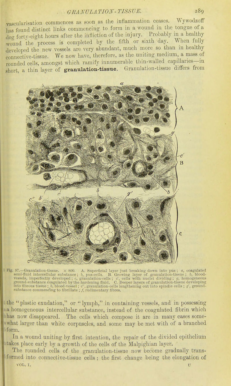 vascularisatioii coramcnces as soon as the infiamniatiou ceases. WywodzofF has found distinct links commencing to form in a wound in the tongue of a doo- fortv-cight hours after the infliction of the injury. Probably m a healthy wound the'process is completed by the fifth or sixth day. When fully developed the new vessels are very abundant, much more so than in healthy connective-tissue. We now have, therefore, as the uniting medium, a mass of rounded cells, amongst which ramify innumerable thin-walled capillaries—in short, a thin layer of granulation-tissue. Granulation-tissue differs from Fig. 97.—Granulation-tissue. X 800. A. Superficial layer just breaking clown into pus ; a, coagulated Henii-Huid intercellular .substance; h, pus-eells. B. Growing layer of granulation-tissue; h, blood- vessels, iniperleetly developed; o, granulation-cells; c', cells with nuclei dividing; i/, homogeneous ground-substance coagulated by the hardening tluid. C. Deeper layers of granulation-tis.sue developing into fibrous tissue; b, blood-vessel; c, granulation-cells lengthening out into spindle cells ; g', ground- substance commending to librillate ; /, rudimentary fibres. the plastic exudation, or lymph, in containing vessels, and in possessing a homogeneous intercellular substance, instead of the coagulated fibrin which has now disappeared. The cells which compose it are in many cases some- what larger than white corpuscles, and some may be met with of a branched form. In a wound uniting by first intention, the repair of the divided epithelium takes place early T)y a growth of the cells of the Malpighian layer. The rounded cells of the granulation-tissue now become gradually trans- formed into connective-tissue cells ; the first change being the elongation of VOL. I. u