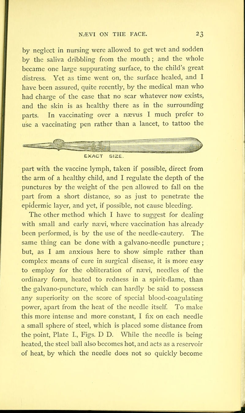 by neglect in nursing were allowed to get wet and sodden by the saliva dribbling from the mouth ; and the whole became one large suppurating surface, to the child's great distress. Yet as time went on, the surface healed, and I have been assured, quite recently, by the medical man who had charge of the case that no scar whatever now exists, and the skin is as healthy there as in the surrounding parts. In vaccinating over a naevus I much prefer to use a vaccinating pen rather than a lancet, to tattoo the EXACT SIZE. part with the vaccine lymph, taken if possible, direct from the arm of a healthy child, and I regulate the depth of the punctures by the weight of the pen allowed to fall on the part from a short distance, so as just to penetrate the epidermic layer, and yet, if possible, not cause bleeding. The other method which I have to suggest for dealing with small and early naevi, where vaccination has already been performed, is by the use of the needle-cautery. The same thing can be done with a galvano-needle puncture; but, as I am anxious here to show simple rather than complex means of cure in surgical disease, it is more easy to employ for the obliteration of naevi, needles of the ordinary form, heated to redness in a spirit-flame, than the galvano-puncture, which can hardly be said to possess any superiority on the score of special blood-coagulating power, apart from the heat of the needle itself To make this more intense and more constant, I fix on each needle a small sphere of steel, which is placed some distance from the point, Plate I., Figs. D D. While the needle is being heated, the steel ball also becomes hot, and acts as a reservoir of heat, by which the needle does not so quickly become