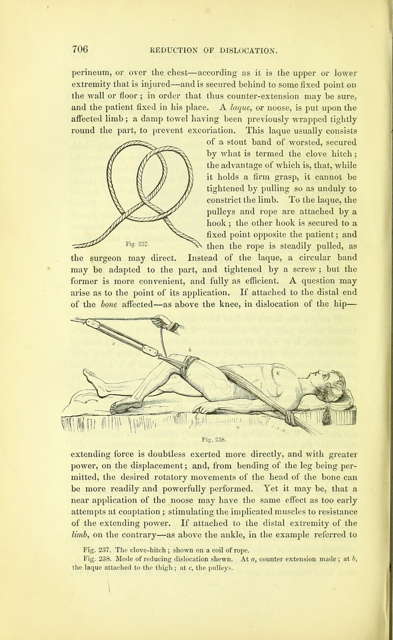 perineum, or over the chest—according as it is the upper or lower extremity that is injured—and is secured behind to some fixed point on the wall or floor ; in order that thus counter-extension may be sure, and the patient fixed in his place. A laque, or noose, is put upon the affected limb; a damp towel having been previously wrapped tightly round the part, to prevent excoriation. This laque usually consists of a stout band of worsted, secured by what is termed the clove hitch; the advantage of which is, that, while it holds a firm grasp, it cannot be tightened by pulling so as unduly to constrict the limb. To the laque, the pulleys and rope are attached by a hook ; the other hook is secured to a fixed point opposite the patient; and then the rope is steadily pulled, as the surgeon may direct. Instead of the laque, a circular band may be adapted to the part, and tightened by a screw ; but the former is more convenient, and fully as efficient. A question may arise as to the point of its application. If attached to the distal end of the hone affected—as above the knee, in dislocation of the hip— Fig. 238. extending force is doubtless exerted moi'e directly, and with greater power, on the displacement; and, from bending of the leg being per- mitted, the desired rotatory movements of the head of the bone can be more readily and powerfully performed. Yet it may be, that a near application of the noose may have the same effect as too early attempts at coaptation ; stimulating the implicated muscles to resistance of the extending power. If attached to the distal extremity of the limh, on the contrary—as above the ankle, in the example referred to Fig. 237. The clove-hitch; shown on a coil of rope. Fig. 238. Mode of reducing dislocation shewn. At a, counter extension made ; at h, the laque attached to the tliigh ; at c, the pulleys. \