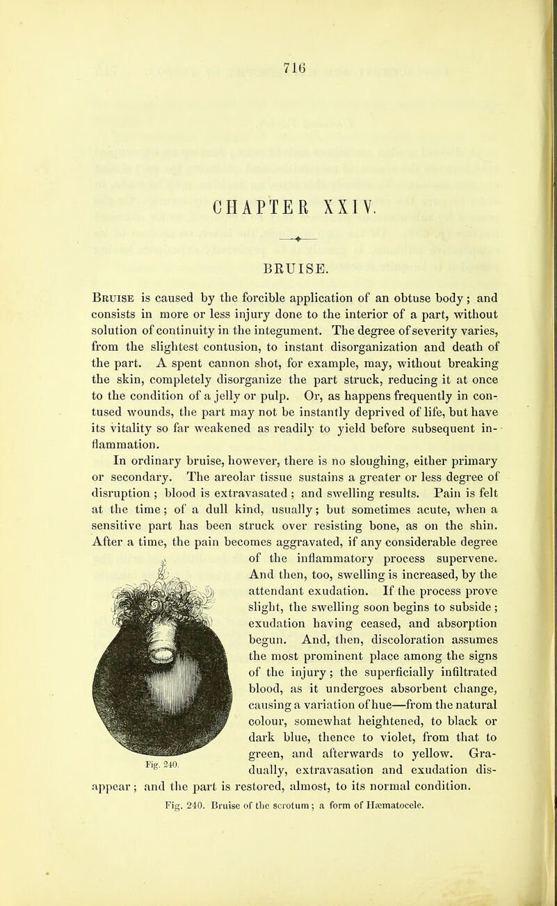 CHAPTER XXIV. BEUISE. Bruise is caused by the forcible application of an obtuse body; and consists in more or less injury done to the interior of a part, without solution of continuity in the integument. The degree of sevei'ity varies, from the slightest contusion, to instant disorganization and death of the part. A spent cannon shot, for example, may, without breaking the skin, completely disorganize the part struck, reducing it at once to the condition of a jelly or pulp. Or, as happens frequently in con- tused wounds, the part may not be instantly deprived of life, but have its vitality so far weakened as readily to yield before subsequent in- flammation. In ordinary bruise, however, there is no sloughing, either primary or secondary. The areolar tissue sustains a greater or less degree of disruption ; blood is extravasated ; and swelling results. Pain is felt at the time; of a dull kind, usually; but sometimes acute, when a sensitive part has been struck over resisting bone, as on the shin. After a time, the pain becomes aggi'avated, if any considerable degree of the inflammatory process supervene. And then, too, swelling is increased, by the attendant exudation. If the process prove slight, the swelling soon begins to subside ; exudation having ceased, and absorption begun. And, then, discoloration assumes the most prominent place among the signs of the injury; the superficially infiltrated blood, as it undergoes absorbent change, causing a variation of hue—from the natural colour, somewhat heightened, to black or dark blue, thence to violet, from that to green, and aftei'wards to yellow. Gra- dually, extravasation and exudation dis- appear ; and the part is restored, almost, to its normal condition. Fig. 240. Bruise of tlic scrotum ; a form of Ilicmatocele. I-'iji:, 210
