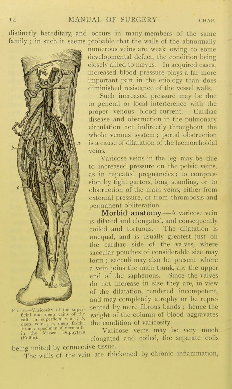 distinctly hereditary, and occurs in many members of the same family ; in such it seems probable that the walls of the abnormally numerous veins are weak owing to some developmental defect, the condition being closely allied to nsevus. In acquired cases, increased blood pressure plays a far more important part in the etiology than does diminished resistance of the vessel walls. Such increased pressure may be due to general or local interference with the proper venous blood current. Cardiac disease and obstruction in the pulmonary circulation act indirectly throughout the whole venous system ; portal obstruction is a cause of dilatation of the hemorrhoidal veins. Varicose veins in the leg may be due to increased pressure on the pelvic veins, as in repeated pregnancies; to compres- sion by tight garters, long standing, or to obstruction of the main veins, either from external pressure, or from thrombosis and permanent obliteration. Morbid anatomy.—A varicose vein is dilated and elongated, and consequently coiled and tortuous. The dilatation is unequal, and is usually greatest just on the cardiac side of the valves, where saccular pouches of considerable size may form; sacculi may also be present where a vein joins the main trunk, e.g. the upper end of the saphenous. Since the valves do not increase in size they are, in view of the dilatation, rendered incompetent, and may completely atrophy or be repre- sented by mere fibrous bands; hence the weight of the column of blood aggravates the condition of varicosity. Varicose veins may be very much elongated and coiled, the separate coils being united by connective tissue. The walls of the vein are thickened by chronic inflammation, r'i(;. 6.—Varicosity of tlic super- ficial and deep veins of the calf. II, superficial veins; deep veins; 6', deep fascia. From a sijecimen of Verneuil's in the Musie Dupuytren (Follin).