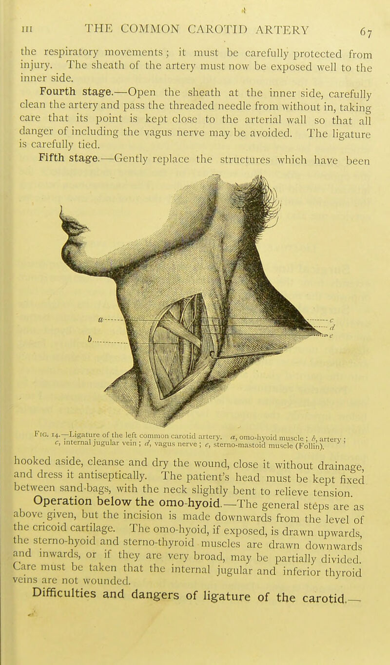 the respiratory movements; it must be carefully protected from injury. The sheath of the artery must now be exposed well to the inner side. Fourth stagre.—Open the sheath at the inner side, carefully clean the artery and pass the threaded needle from without in, taking care that its point is kept close to the arterial wall so that all danger of including the vagus nerve may be avoided. The ligature is carefully tied. Fifth stage.—Gently replace the structures which have been Fig. 14.—Ligature of tlie left common carotid artery. «, omo-liyoid muscle • /, arter\- • c, internal jugular vein ; vagus nerve ; e, sterno-mastoid muscle (Follin). ' hooked aside, cleanse and dry the wound, close it without drainac^e and dress it antiseptically. The patient's head must be kept fixed between sand-bags, with the neck slightly bent to relieve tension Operation below the omo-hyoid.—The general steps are as above given, but the incision is made downwards from the level of the cricoid cartilage. The omo-hyoid, if exposed, is drawn upwards the sterno-hyoid and sterno-thyroid muscles are drawn downwards and mward.s, or if they are very broad, may be partially divided Care must be taken that the internal jugular and inferior thyroid veins are not wounded. Difficulties and dangers of ligature of the carotid.—