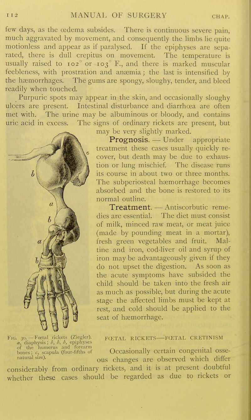 few days, as the oedema subsides. There is continuous severe pain, much aggravated by movement, and consequently the limbs lie quite motionless and appear as if paralysed. If the epiphyses are sepa- rated, there is dull crepitus on movement. The temperature is usually raised to 102'^ or 103 F., and there is marked mu.scular feebleness, with prostration and ancemia; the last is intensified by the haemorrhages. The gums are spongy, sloughy, tender, and bleed readily when touched. Purpuric spots may appear in the skin, and occasionally sloughy ulcers are present. Intestinal disturbance and diarrhoea are often met with. The urine may be albuminous or bloody, and contains uric acid in excess. The signs of ordinary rickets are present, but may be very slightly marked. Prognosis. — Under appropriate treatment these cases usually quickly re- cover, but death may be due to exhaus- tion or lung mischief. The disease runs its course in about two or three months. The subperiosteal haemorrhage becomes absorbed and the bone is restored to its normal outline. Treatment. — Antiscorbutic reme- dies are essential. The diet must consi.st of milk, minced raw meat, or meat juice (made by pounding meat in a mortar), fresh green vegetables and fruit. Mal- tine and iron, cod-liver oil and syrup of iron may be advantageously given if they do not upset the digestion. As soon as the acute symptoms have subsided the child should be taken into the fresh air as much as possible, but during the acute stage the affected limbs must be kept at rest, and cold should be applied to the seat of htemorrhage. Kk;. 30. — Foetal rickets (Zieglcr). a, diaphysis ; epiphyses of the humerus and forearm bones ; c, scapula (four-fifths of natural size). FCET.'VL RICKETS KOET.VL CRETINISM Occasionally certain congenital osse- ous changes are observed which differ considerably from ordinary rickets, and it is at present doubtful whether these cases should be regarded as due to rickets or