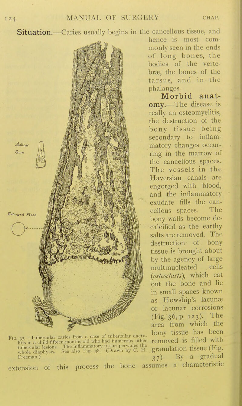 Situation.—Caries usually begins in Ihc cancellous tissue, and hence is most com- monly seen in the ends of long bones, the bodies of the verte- brae, the bones of the tarsus, and in the phalanges. Morbid anat- omy.—The disease is really an osteomyelitis, the destruction of the bony tissue being secondary to inflam- matory changes occur- ring in the marrow of the cancellous spaces. The vessels in the Haversian canals are engorged with blood, and the inflammatory exudate fills the can- cellous spaces. The bony walls become de- calcified as the earthy salts are removed. The destruction of bony tissue is brought about by the agency of large multinucleated . cells {osteoclasis), which eat out the bone and lie in small spaces known as Howship's lacunas or lacunar corrosions (Fig. 36, p. 123). The area from which the .^, , II, bony tissue has been KiG. 37.—Tubercul.-ir canes from a case of UibercuL-ir d.^a^ - . litis in a child fifleeii moiitlis old who lu-iJ numerous other rCmOVCd IS nllea ^^HI^ tubercular lesions. The innaiu.natory tissue pervades the fisSUC (Fic whole diaphysis. See also iMg. 38. (Drawn by C. H. giaUUiaUOn LlbbLll, \i- IL, Freeman.) 2 7). By a gradual extension of this process the bone assumes a characteristic