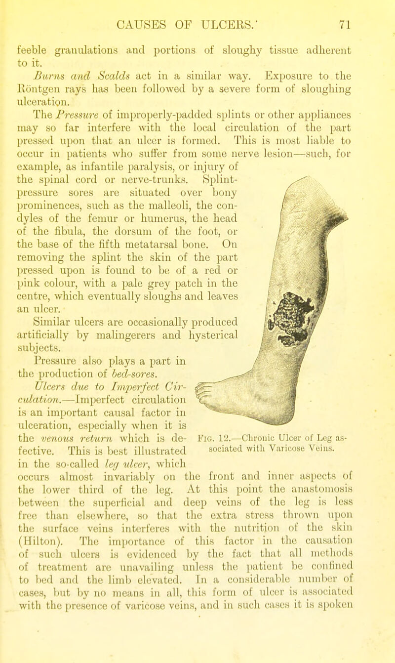 feeble granulations and portions of sloughy tissue adherent to it. Burns and Scalds act in a similar way. Exposure to the Ili3ntgen rays has been followed by a severe form of sloughing ulceration. Tlie Pressure of improperly-padded splints or other appliances may so far interfere wth the local circulation of the part pressed upon that an ulcer is formed. This is most liable to occur in patients who suffer from some nerve lesion—such, for example, as infantile paralysis, or injury of the spinal cord or nerve-trunks. S2:>lint- prcssure sores are situated over bony prominences, such as the malleoli, the con- dyles of the femur or humerus, the head of the fibula, the dorsum of the foot, or the base of the fifth metatarsal bone. On removing the splint the skin of the part l»ressed upon is found to be of a red or l)ink colour, with a pale grey patch in the centre, which eventually sloughs and leaves an ulcer. Similar ulcers are occasionally produced artificially by malingerers and hysterical subjects. Pressure also plays a part in the production of bed-sores. Ulcers due to Imperfect Cir- culation.—-Imperfect circulation is an important causal factor in ulceration, especially when it is the venous retimi which is de- fective. This is best illustrated in the so-called leg ulcer, which occurs almost invariably on the front and inner aspects of the lower third of the leg. At this point the anastomosis between the superficial and deep veins of the leg is less free than elsewhere, so that the extra stress thrown upon the surface veins interferes with the nutrition of the skin (Hilton). The importance of this factor in the causation of such ulcers is evidenced by the fact that all methods of treatment arc unavailing unless the i)atient be confined to bed and the limb elevated. In a consideraljle miniber of cases, but by no means in all, this form of ulcer is associated with the presence of varicose veins, and in such cases it is spoken Fia. 12.—Clii'onic Ulcer of Leg as- sociated with Varicose Veins.