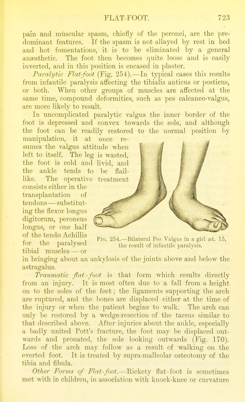 pain and muscular spasm, chiefly of the peronei, are the pre- dominant features. If the spasm is not allayed by rest in bed and hot fomentations, it is to be eliminated by a general ansesthetic. The foot then becomes quite loose and is easily inverted, and in this position is encased in plaster. Paralytic Flat-foot (Fig. 254).—In typical cases this results from infantile paralysis affecting the tibialis anticus or posticus, or both. When other groups of muscles are affected at the same time, compound deformities, such as pes calcaneo-valgus, are more likely to result. In uncomplicated paralytic valgus the inner border of the foot is depressed and convex towards the sole, and although the foot can be readily restored to the normal position by manipulation, it at once re- sumes the valgus attitude when left to itself. The leg is wasted, livid, and be flail- treatment Fif). 254.—Bilateral Pes Valgus in a girl tet. 15, the result of iufautile paralysis. the foot is cold and the ankle tends to like. The operative consists either in the transplantation of tendons—substitut- ing the flexor longus digitorum, peroneus longus, or one half of the ten do Achillis for the paralysed tibial muscles — or in bringing about an ankylosis of the joints above and below the astragalus. Travmatic flat-foot is that form which results directly from an injury. It is most often due to a fall from a height on to the soles of the feet; the ligaments supporting the arch are ruptured, and the bones are displaced either at the time of the injury or when the patient begins to walk. The arch can only be restored by a wedge-resection of the tarsus similar to that described above. After injuries about the ankle, especially a badly united Pott's fracture, the foot may be displaced out- wards and pronatcd, the sole looking outwards (Fig. 170). Loss of the arch may follow as a result of walking on the everted foot. It is treated by aupra-malleolar osteotomy of the tibia and fibula. Other Fornix of Flat-font.—Uickety Hat-foot is sometimes met with in children, in association with knock-knee or curvature