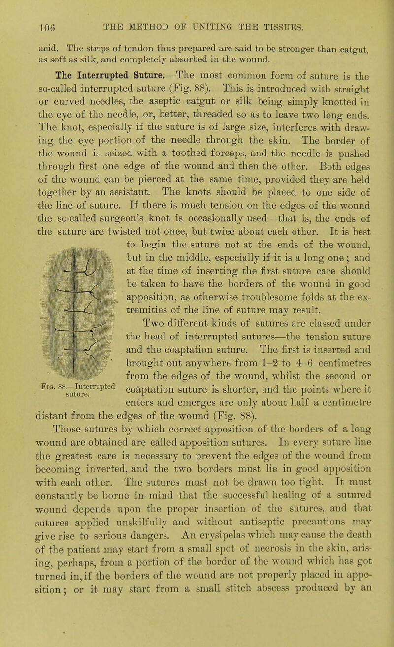 acid. The strips of tendon thus preijared are said to be stronger than catgut, as soft as silk, and completely absorbed in the wound. The Interrupted Suture.—The most common form of suture is the so-called interrupted suture (Fig. 88). This is introduced with straiglit or curved needles, the aseptic catgut or silk being simply knotted in the eye of the needle, or, better, threaded so as to leave two long ends. The knot, especially if the suture is of large size, interferes with draw- ing the eye portion of the needle through the skin. The border of the wound is seized with a toothed forceps, and the needle is pushed through first one edge of the wound and then the other. Both edges of the wound can be pierced at the same time, provided they are held together by an assistant. The knots should be placed to one side of the line of suture. If there is much tension on the edges of the wound the so-called surgeon's knot is occasionally used—that is, the ends of the suture are twisted not once, but twice about each other. It is best to begin the suture not at the ends of the wound, but in the middle, especially if it is a long one; and at the time of inserting the first suture care should be taken to have the borders of the wound in good apposition, a,8 otherwise troublesome folds at the ex- tremities of the line of suture may result. Two different kinds of sutures are classed under the head of interrupted sutures—the tension suture and the coaptation suture. The first is inserted and brought out anywhere from 1-2 to 4-6 centimetres from the edges of the wound, whilst the second or coaptation suture is shorter, and the points where it enters and emerges are only about half a centimetre distant from the edges of the wound (Fig. 88). Those sutures by which correct apposition of the borders of a long wound are obtained are called apposition sutures. In every suture line the greatest care is necessary to prevent the edges of the wound from becoming inverted, and the two borders must lie in good apposition with each other. The sutures must not be drawn too tight. It must constantly be borne in mind that the successful healing of a sutured wound depends upon the proper insertion of the sutures, and that sutures applied unskilfully and without antiseptic precautions may give rise to serious dangers. An erysipelas which may cause the death of the patient may start from a small spot of necrosis in the skin, aris- ing, perhaps, from a portion of the border of the wound which has got turned in, if the borders of the wound are not properly placed in appo- sition; or it may start from a small stitch abscess produced by an Fio. 88.—lutemipted suture.