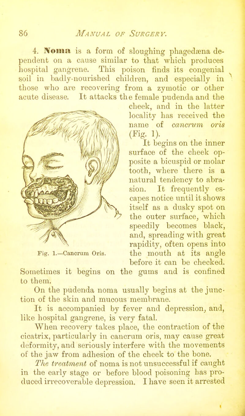 4. IVoina is a form of sloughing phagedsena de- pendent on a cause similar to that which produces hospital gangrene. This poison finds its congenial soil in badly-nourished children, and especially in those who are recovering from a zymotic or other acute disease. It attacks th e female pudenda and the cheek, and in the latter locality has received the name of cancrvm oris It begins on the inner surface of the cheek op- posite a bicuspid or molar tooth, where there is a natural tendency to abra- sion. It frequently es- capes notice until it shows itself as a dusky spot on the outer surface, which speedily becomes black, and, spreading with great rapidity, often opens into the mouth at its angle before it can be checked. Sometimes it begins on the gums and is confined to them. On the pudenda noma usually begins at the junc- tion of the skin and mucous membrane. It is accompanied by fever and depression, and, like hospital gangrene, is very fatal. When recovery takes place, the contraction of the cicatrix, particularly in cancram oris, may cause great defoi'mity, and seriously interfere with the movements of the jaw from adhesion of the cheek to the bone. The treatment of noma is not unsuccessful if caught in the early stage or before blood poisoning has pro- duced irrecoverable depression. I have seen it arrested Fig. 1.—Cancriim Oi-is.