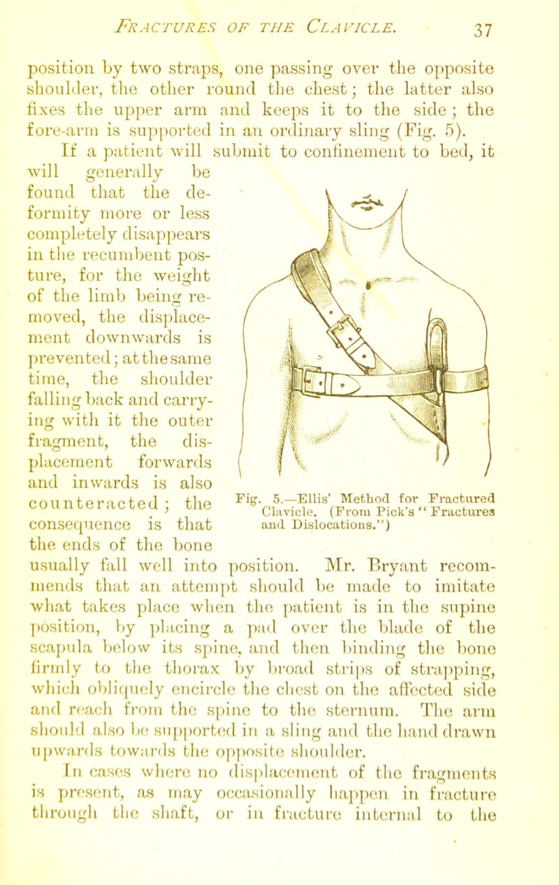 position by two straps, one passing over the opposite shoukler, tlie other round the cliest; the latter also fixes the upper arm and keeps it to the side ; the fore-arm is supported in an ordiiiary sling (Fig. 5). If a patient will submit to confinement to bed, it will generally be found that the de- formity more or less completely disappears in the recumbent pos- ture, for the weight of the limb being re- moved, the displace- ment downwards is prevented; attliesame time, the shoulder falling back and carry- ing with it the outer fragment, the dis- placement forwards and inwards is also counteracted; the consequence is that the ends of the bone usually fall well into position. Mr. Bry.ant recom- mends that an attempt should be made to imitate what takes place when the patient is in the supine position, by pUicing a pad over the blade of the scapula Ijelow its spine, and then liinding tlie bone firmly to tlie thorax by bi'oad strips of strajjping, which obliquely encircle the chest on the affected side and reach from the spine to the sternum. Tlio arm should also \n\ supported in a sling and the hand drawn upwards towards the oppo.site shoulder. In cases where no dis|ilac(^ment of the fragUKmts is present, a.s may occasionally ha])pen in fracture through the shaft, or in fracture internal to the Fig. .5.—Ellis' Metliod for Clavicle. (From Pick's aud Dislocations.) Fractured ' Fractures