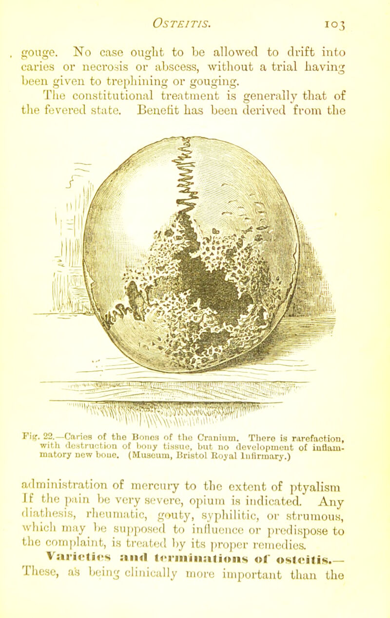 gouge. No case ought to be allowed to drift into caries or necrosis or abscess, without a trial having been given to trephining or gouging. The constitutional treatment is generally that of the fevered state. Benefit has been derived from the Fii». 22.—Caries of the Bonos of the Cranium. There is rarefaction, with destruction of bony tissue, but no development of inflam- matory new boue. (Museum, Bristol Royal lufirmary.) admini.stration of incrcuiy to the extent of ptyalisra If the pain be very severe, opium is indicated. Any diathesis, rheumatic, gouty, syphilitic, or strumous, whicli may be supposed to influence or predispose to the complaint, is trcalrM! hy its p?'oper remedies. VariotM's :iimI tcriniiiaiions of osloiti<«.— These, as being clinically more important than the