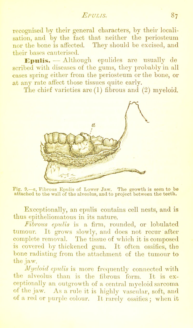 recognised by their general characters, by their locali- sation, and by the fact that neither the periosteum nor the bone is atTected. They should be excised, and their bases cauterised. Epulis. — Altliougli epulides are usually de scribed with diseases of the gums, they probably in all cases spring either from the periosteum or the bone, or at any rate affect those tissues quite early. The chief varieties are(l) fibrous and (2) myeloid. Pig. 9.—a, Fibrous Epulis of Lower Jaw. The growth is seen to be attached to the wall of the alveolus, and to project between the teeth. Exceptionally, an epulis contains cell nests, and is thus epitheliomatous in its nature. Fibrous epulis is a finn, rounded, or lobulated tumour. It grows slowly, and does not recur after complete removal. The tissue of which it is comj^osed is covered by thickened gum. It often ossifies, tho bone radiating from the attachment of the tumour to tlie Jaw. iMypJoid epulis is moiv; frequently connected wii-li the alveolus than is the fibrous form. It is ex- ceptionally an outgrowth of a central myeloid sarcoma of the jaw. As a ruh; it is highly vascular, soft, and of a I'ed or purple colour. It rarely ossides; wluni it