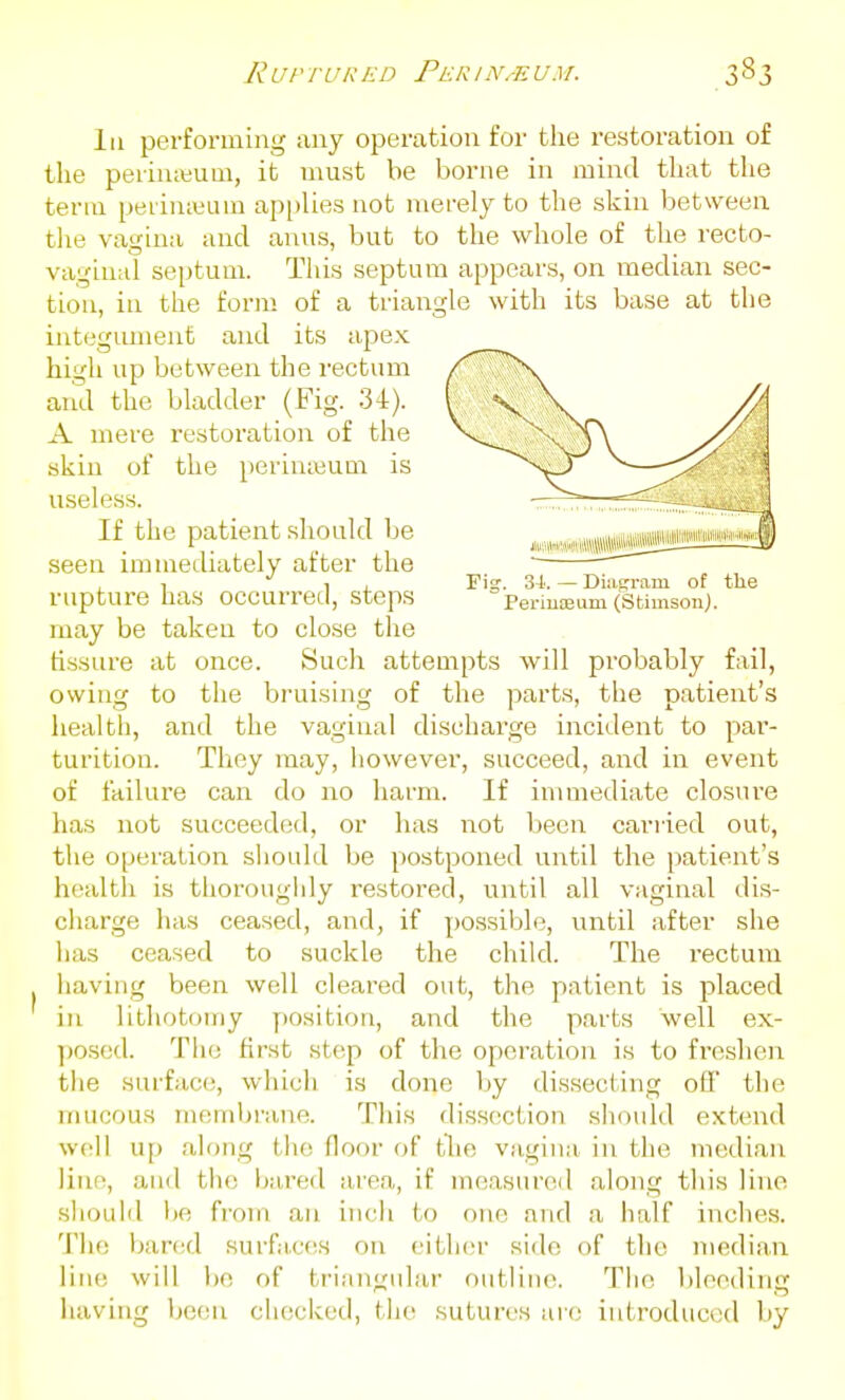 li LrrruRed Perin.-eum. Ill perforoiing any operation for the restoration of the peiin;«um, it must be borne in mind that the term peiinieuui applies not merely to the skin between the vagina and anus, but to the whole of the recto- vaginal septum. This septum appears, on median sec- tion, in the form of a triangle with its base at the integument and its aj^e.x. high up between the rectum and the bladder (Fig. 34). A mere restoration of the skin of the perinieum is useless. If the patient should Ije ,,i,.,,M,«w^^ seen innuediately after the ~ ' 1 1 , Fig. 34. — Diaprram ot tlie rupture has occurred, steps Periuajum (Stimsonj. may be taken to close the fissure at once. Sucli attempts will probably fail, owing to the bruising of the parts, the patient's health, and the vaginal discharge incident to par- turition. They may, however, succeed, and in event of failure can do no harm. If immediate closure has not succeeded, or has not been cariied out, the operation should be postponed until the patient's health is thorougidy restored, until all vaginal dis- charge has ceased, and, if possible, until after she has ceased to suckle the child. The rectum having been well cleared out, the patient is placed in lithotomy y)Osition, and the parts well ex- posed. The first step of the operation is to freshen the surface, which is done Ijy dissecting off the mucous membrane. This dissection should extend \sv\\ up along the floor of the vagina in the median line, and tii(3 bared area, if mciasured along this line .should lie from an inch to one and a half inches. The bared surfa,c(!S on eitlnjr side of the median line will l)e of triangular outline. Tiie bleeding having been checked, the sutures are introduced by