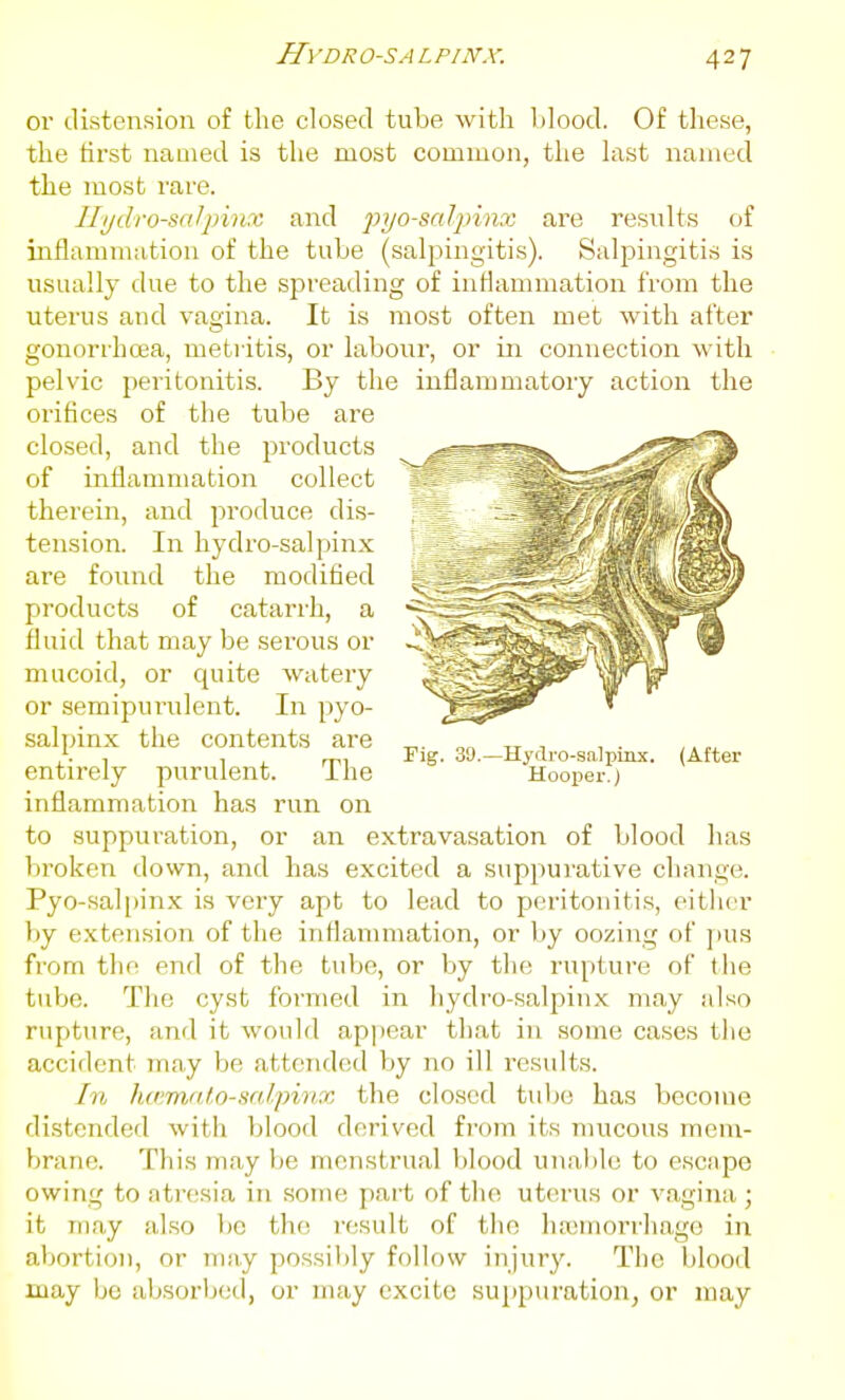 H\ 'DR OS A L PI NX. or distension o£ the closed tube with blood. Of these, the first named is the most common, the last named the most rare. Ilydro-snJjnnx and pj/o-salpinx are results of inflammation of the tube (salpingitis). Salpingitis is usually due to the spreading of inflammation from the uterus and vagina. It is most often met with after gonorrhoea, metritis, or labour, or in connection with pelvic peritonitis. By the inflammatory action the orifices of the tube are closed, and the products of inflammation collect therein, and produce dis- tension. In hydro-sal pinx are found the modified products of catarrh, a fluid that may be serous or mucoid, or quite watery or semipui'ulent. In pyo- salpinx the contents are entirely purulent. The inflammation has run on to suppuration, or an extravasation of blood has broken down, and has excited a suppurative change. Pyo-salpinx is very apt to lead to peritoniti.s, either by extension of the inflammation, or by oozing of pus from the end of the tulje, or by the rupture of the tube. The cyst formed in hydi'o-salpinx may also rupture, and it would appear that in some cases the accident may be attended by no ill results. In hami'do-snf.pi'ii.x the clo.sed tube has become distended with blood derived from its mucous mem- brane. This may be menstrual blood unable to escape owing to ati'esia in some part of the ut(!rus or vagina; it may also lie the result of the hajmorrhago in abortion, or may possibly follow injury. The blood may be absorbed, or may excite suppuration, or may Fig. 39,—Hydro-saliiinx. (After Hoojjer. J