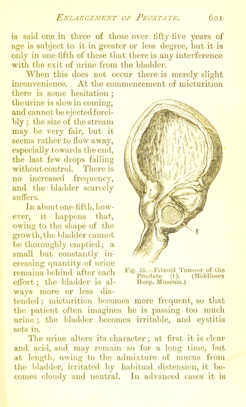 is said one in three of those over fifty-five yeai's of age is subject to it in greater or less degree, but it is only in one-fifth of these that there is any interference with the exit of urine from the bkidder. When this does not occur there is merely slight inconvenience. At the commencement of micturition there is some hesitation ; the urine is slow in coming, and cannot be ejected forci- bly ; the size of the stream may be very fair, but it seems rather to flow away, especially towards the end, the last few drops falling without conti'ol. There is no increased frequency, and the bladder scarcely suffers. In about one-fifth, how- ever, it happens that, owing to the siiape of the growth, the Vjladder cannot be thoroughly emptied; a small but constantly in- ci'easing quantity of urine remains behind after each ^'^ effort; the bladder is al- ways more or less dis- tended ; micturition becomes more frequent, so that the patient often imagines he is passing too much urine ; the bladder becomes irritable, and cystitis sets in. The urine alters its cliaracter; at first it is clear and acid, and may remain so for a long time, but at length, owing to tlie admixture of mucus from the l)ladd('r, irritated by habitual distension, it be- comes cloudy and neutral. In advanced cases it is 65.—Fibroid Tumour of llio Prootato (t). (Middlesex Hosj). Museum.)