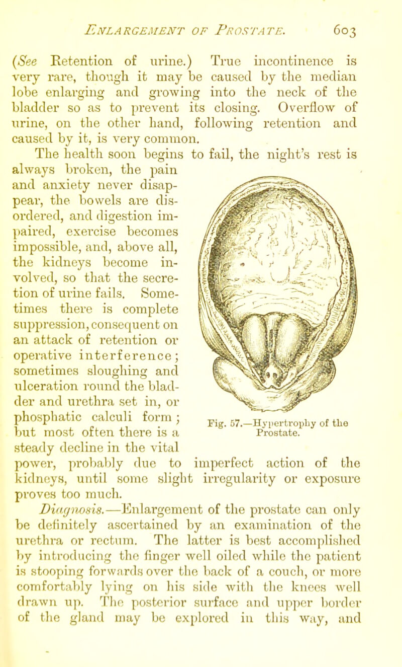 {See Ketention of urine.) True incontinence is very rare, though it may be caused by the median lobe enlarging and growing into the neck of the bladder so as to prevent its closing. Overflow of urine, on the other hand, following retention and caused by it, is very common. The health soon begins to fail, the night's rest is always broken, the pain and anxiety never disap- pear, the bowels are dis- ordered, and digestion im- paired, exercise becomes impossible, and, above all, the kidneys become in- volved, so that the secre- tion of urine fails. Some- times there is complete suppression, consequent on an attack of retention or operative interference; sometimes sloughing and ulceration round the blad- der and urethra set in, or phosphatic calculi form ; but most often there is a steady decline in the vital power, probably due to imperfect action of the kidneys, until some slight irregularity or exposure proves too much. Diagnosis.—Enlargement of the prostate can only be definitely ascertained by an examination of the urethra or rectum. The latter is best accomplished by introducing the finger well oiled while the patient is stooping forwards over the back of a couch, or more comfortably lying on his side with tlie knees well drawn up. The posterior surface and upper border of the gland may be explored in this way, and Fig. 57.—Hypertroiiby of the Prostate.