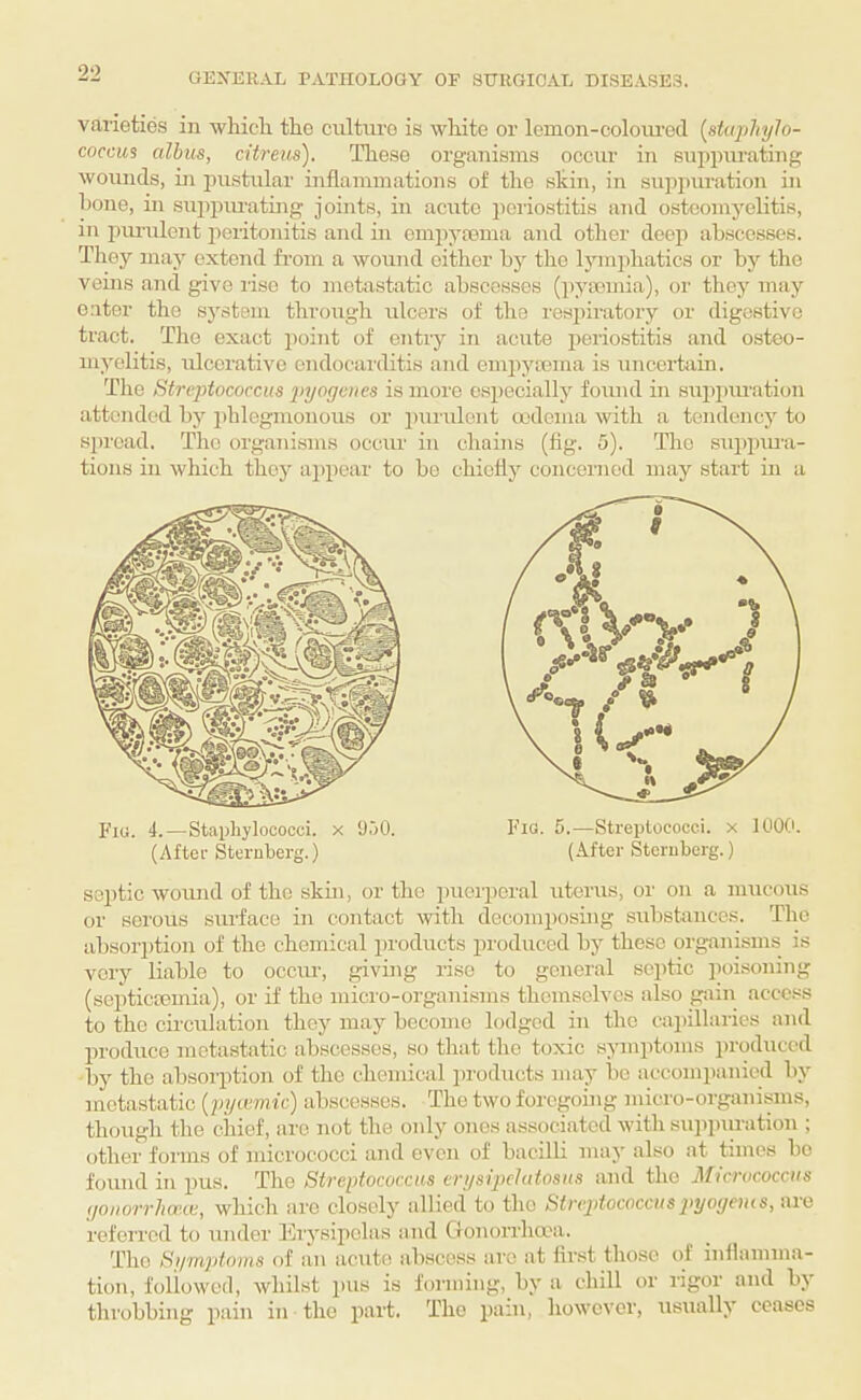 varieties in whicli the culture is white or lemon-coloui’od {staphylo¬ coccus albus, citreus). These organisms occur in suppiuating wounds, in pustular inflammations of the shin, in supiuiration in hone, in suppiu-ating joints, in acute periostitis and osteomyelitis, in piu’ulent peritonitis and in empytema and other deep abscesses. They may extend from a wound either by the lymphatics or by the veins and give rise to metastatic abscesses (ityicmia), or they may eater the s3'6tom through ulcers of the respiratory or digestive tract. The exact point of cntiy in acute periostitis and osteo- ny'olitis, ulcerative endocarditis and emjij’^rema is uncei'tain. Tlie Streptococcus jiyogeucs is more e.speciallj' found in suppiuation attended bj'’ phlegmonous or i)urulont oodema with a tendenej^ to sjjrcad. The organisms occur in chains (fig. 5). The suppm-a- tioiiH in which they appear to bo chicflj concerned may start in a Fio. 4.—Staphylococci, x 950. (After Sternberg.) Fig. 5.—Streptococci, x 1000. (After Sternberg.) septic wound of the skm, or the pueipcral uterus, or on a mucous or serous siudace in contact with decomposing substances. The absor])tion of the chemical products xiroduced bj”^ these organisms is very liable to occur, giving rise to general septic jioisoning (septiciemia), or if the micro-organisms themselves also gain access to the circulation thej' may become lodged in the ca])illarics and produce metastatic abscesses, so that the toxic symiitoms produced by the absorption of the chemical products may bo accompanied by metastatic {pyoimic) abscesses. The two foregoing micro-organisms, though the chief, are not the only ones associated with suppuration ; other forms of micrococci and even of bacilli may also at times be found in pus. The Streptococcus crysipclutosus and the Micrococcus </ouorrhcete, which are closelj’’ allied to the Streptococcuspyoyeius, are referred to under Ei'j^sipelas and Cronorrlio'a. The Si/mptoins of an acute abscess arc at first those of inflamma¬ tion, followed, whilst pus is forming, by' a chill or rigor and bj' thi’obbing pain in the part. The pain, however, usuall}' ceases