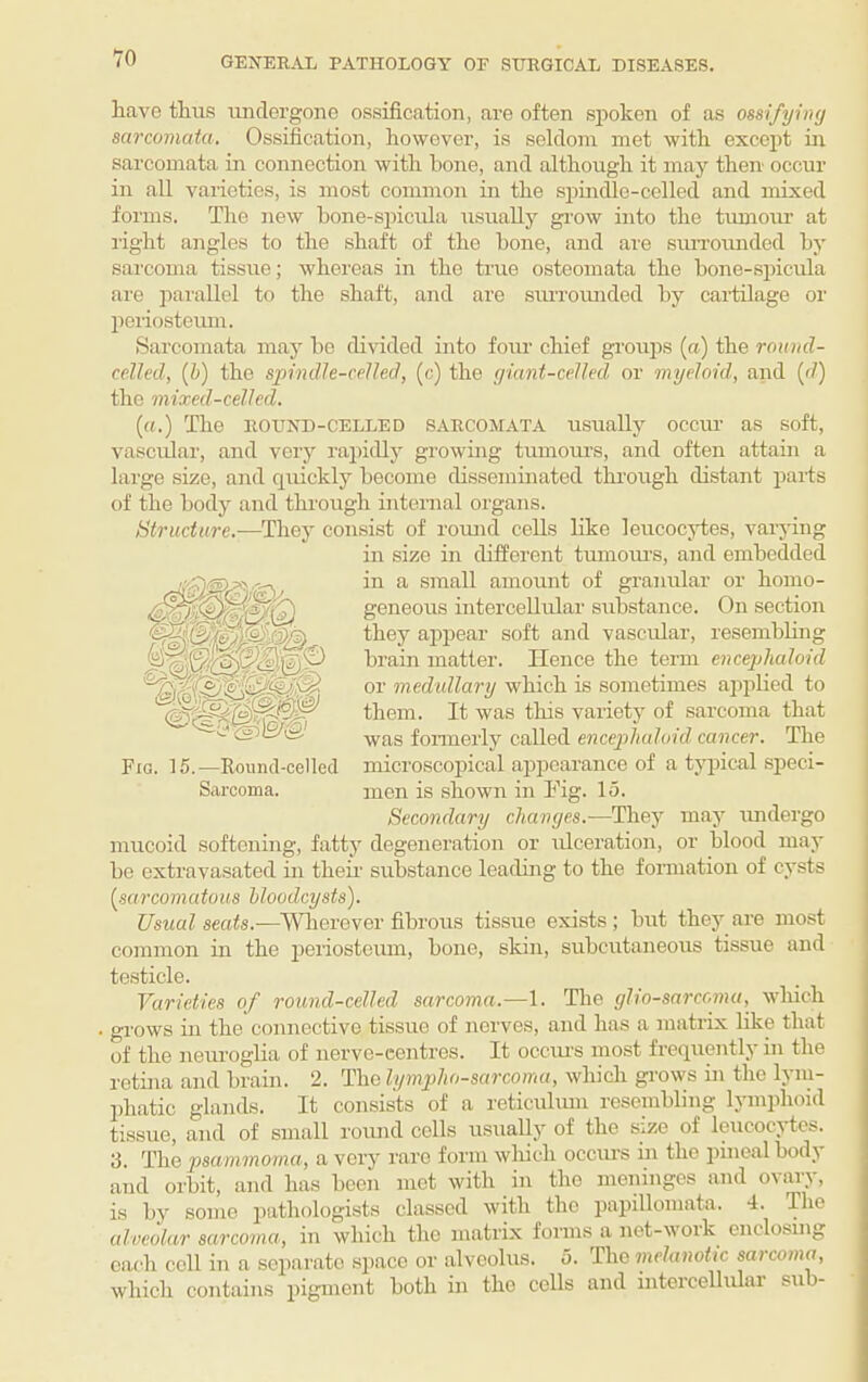 have thus imdergone ossification, are often siioken of as omfyhuj sarcomata. Ossification, however, is seldom met with except in sarcomata in connection with hone, and although it may then occur in all varieties, is most common in the spindle-celled and mixed forms. The new hone-spicida usually grow into the timiour at right angles to the shaft of the bone, and are surroimded by sarcoma tissue; whereas in the true osteomata the bone-spicula are parallel to the shaft, and are siuToiuided by cartilage or lieiiosteum. Sarcomata may bo chvided into foim chief groups (a) the round- celled, (b) the spindle-celled, (c) the cjiant-celled or myeloid, and (d) the mixed-celled. («.) The ROUND-CELLED SARCOMATA usually occur as soft, vascular, and very rapidlj^ growing tumom’s, and often attain a large size, and quickly become disseminated thi’ough distant parts of the body and through internal organs. Structure.—They consist of roimd cells hke leucocytes, vaiyiug in size in chfferent tumoiu’S, and embedded in a small amount of granular or homo¬ geneous intercellular substance. On section they appear soft and vascular, resembling brain matter. Hence the term encephaloid or medullary which is sometimes ajiiilied to them. It was this variety of sarcoma that was fonnerly called encephaloid cancer. The microscoiiical appearance of a tjqiical speci¬ men is shown in Fig. 15. Secondary changes.—They may imdergo mucoid softening, fattj' degeneration or ulceration, or blood may bo extravasated in theii' substance leading to the fonuation of cysts {sarcomatous bloodcysts). Usual seats.—Wlierever fibrous tissue exists ; but they are most common in the periosteum, bone, skin, subcutaneous tissue and testicle. Varieties of round-celled sarcoma.—1. The gho-sarcoma, wliich . grows in the connective tissue of nerves, and has a matrix like that of the neuroglia of nerve-centres. It occiu-s most frequently in the retina and brain. 2. The lymphosarcoma, which grows in the lym¬ phatic glands. It consists of a reticulmu resembling lymplioid tissue, and of small round colls usually of the size of leucocytes. 3. The psammoma, a very rare form wliich occurs in the jiincalbodj and orbit, and has been met with in the meninges and ovary, is by some pathologists classed with the papillomata. 4. The cdveolar sarcoma, in which the matrix forms a net-work enclosing each coll in a separate space or alveolus. 5. The Dicfwwoiic sarcoma, which contains pigment both in the cells and intercellulai sub- Fig. 15.—Round-celled Sarcoma.